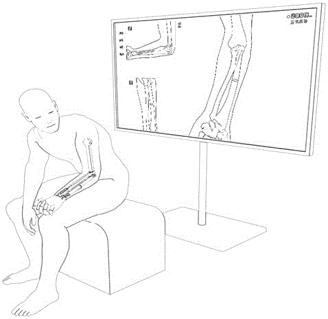 Human body forearm fracture simulating bone-setting training apparatus