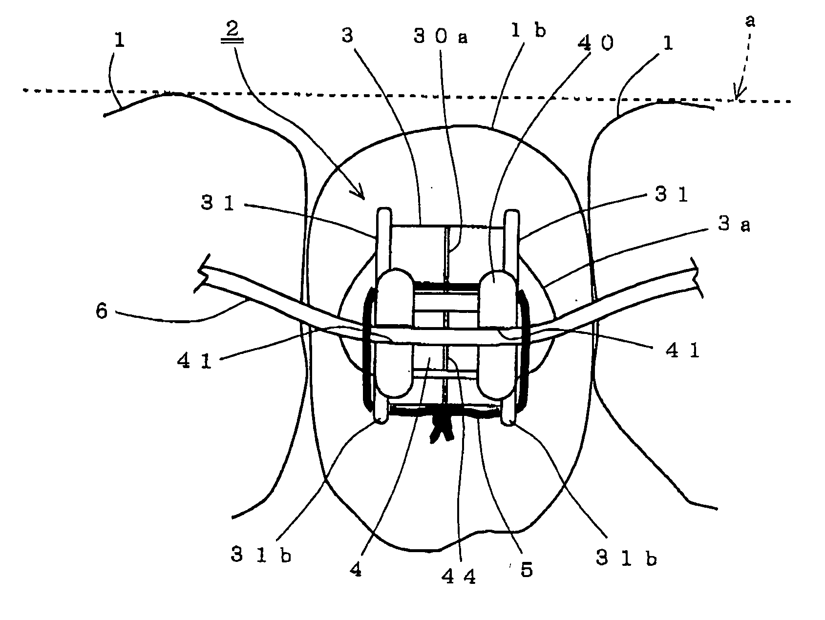 Orthodontic bracket