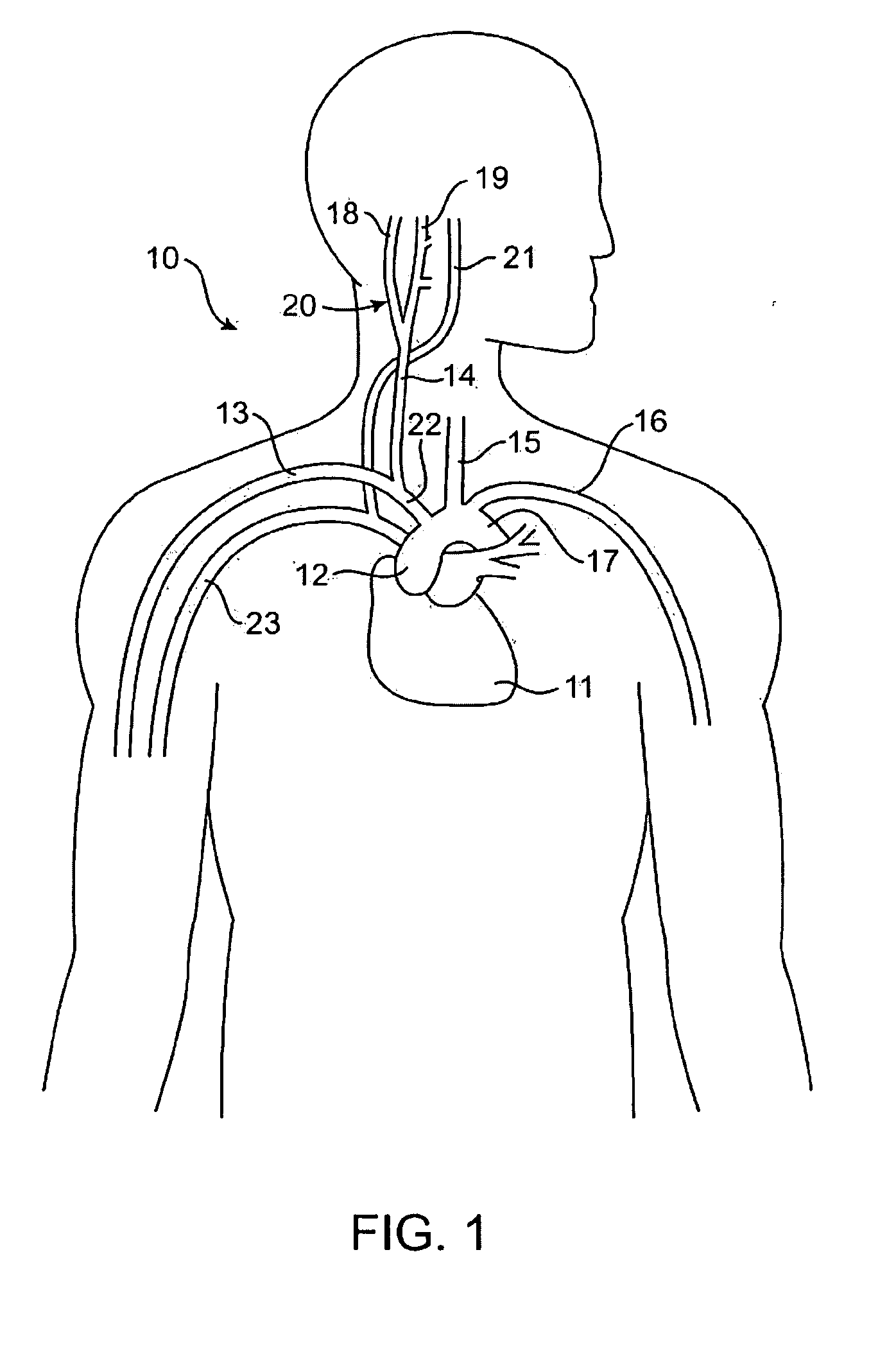 External Baroreflex Activation