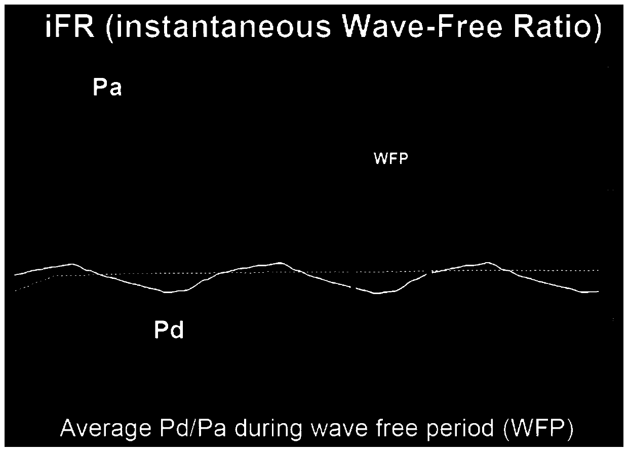 Method for calculating instantaneous waveform-free ratio based on pressure sensor and contrast image