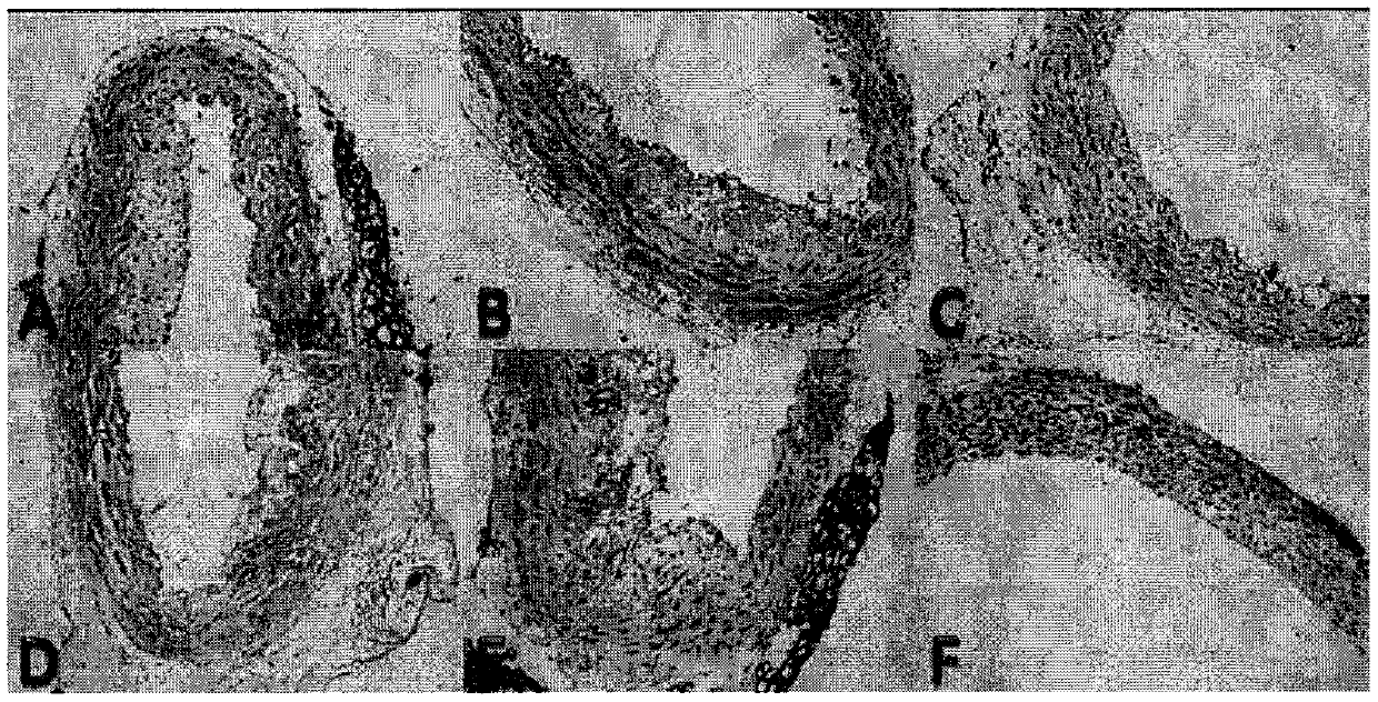 Traditional Chinese medicine composition, medicine containing traditional Chinese medicine composition, preparation method and application thereof