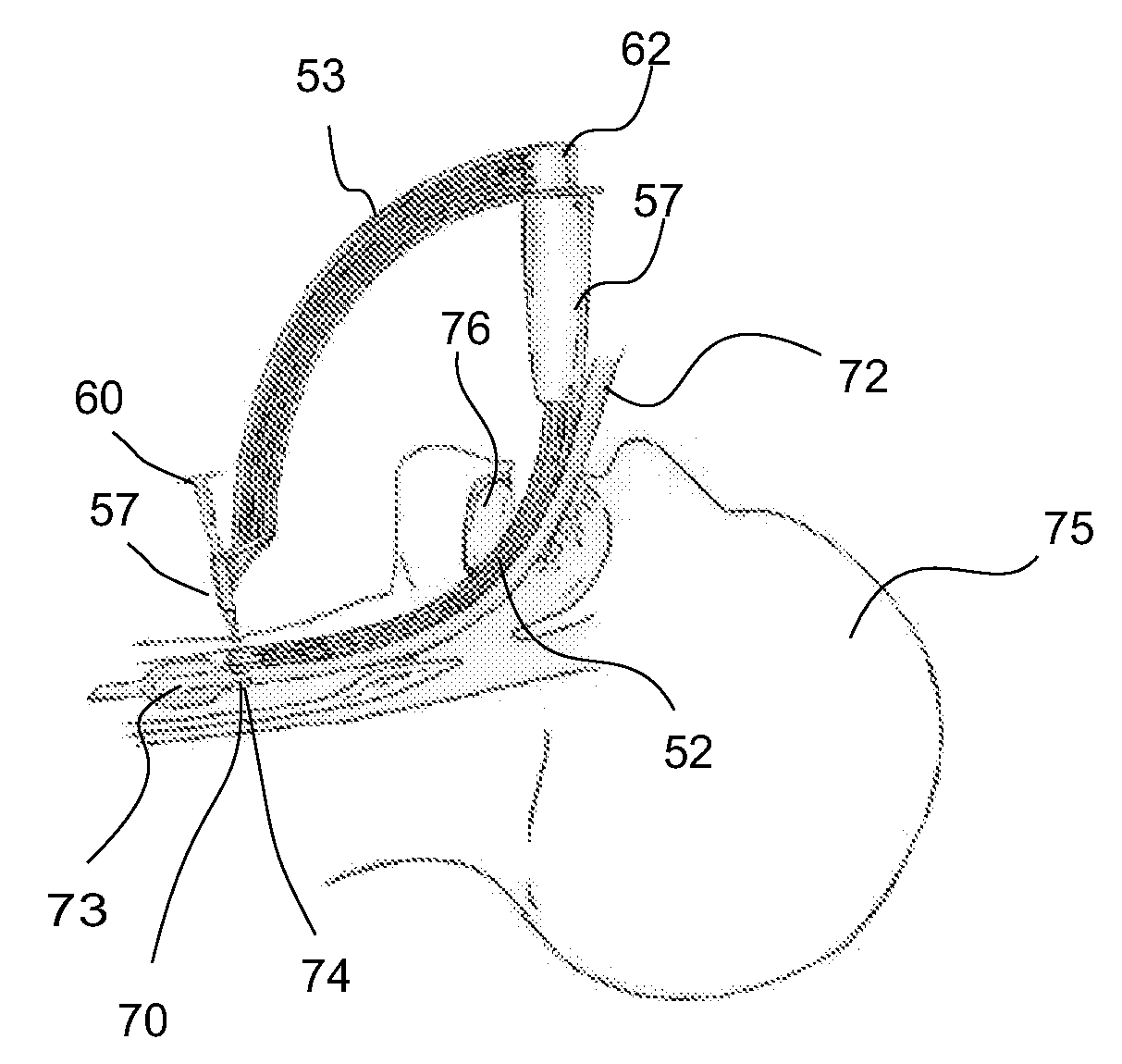 Dilator assembly, a device for facilitating tracheostomy and methods of making a percutaneous tracheostoma