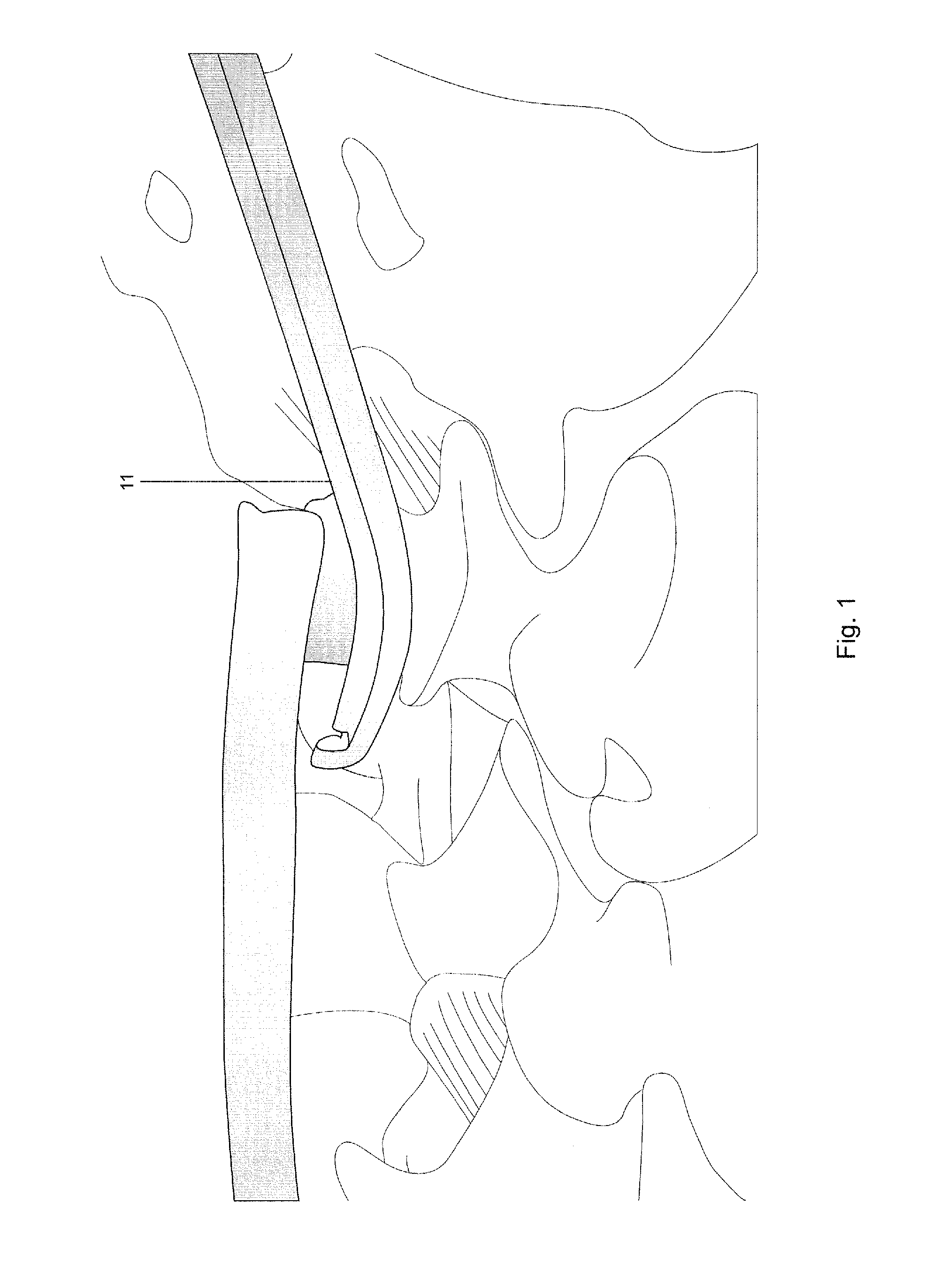 Instruments and Method of Use for Minimally Invasive Spine Surgery in Interspine Space Through Only One Side