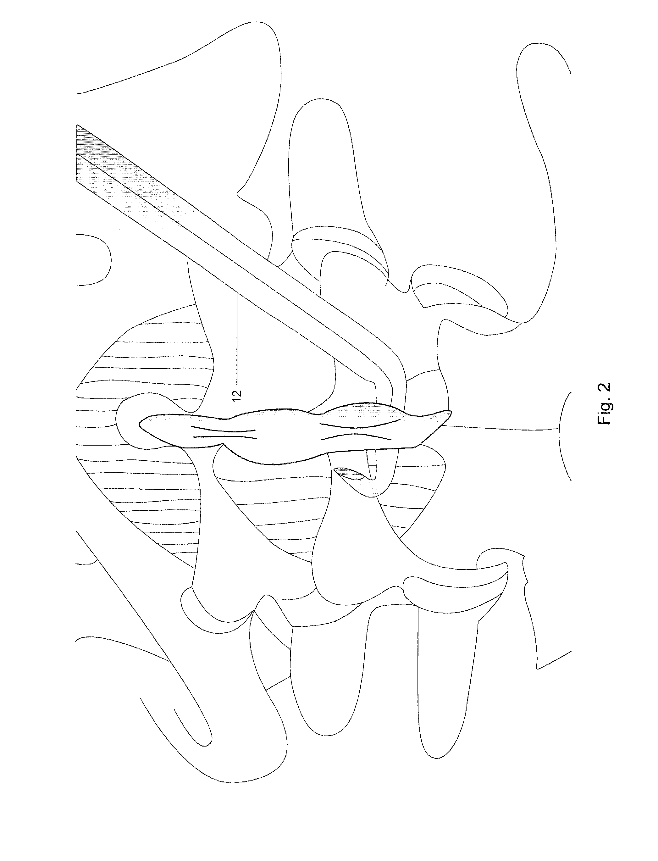 Instruments and Method of Use for Minimally Invasive Spine Surgery in Interspine Space Through Only One Side