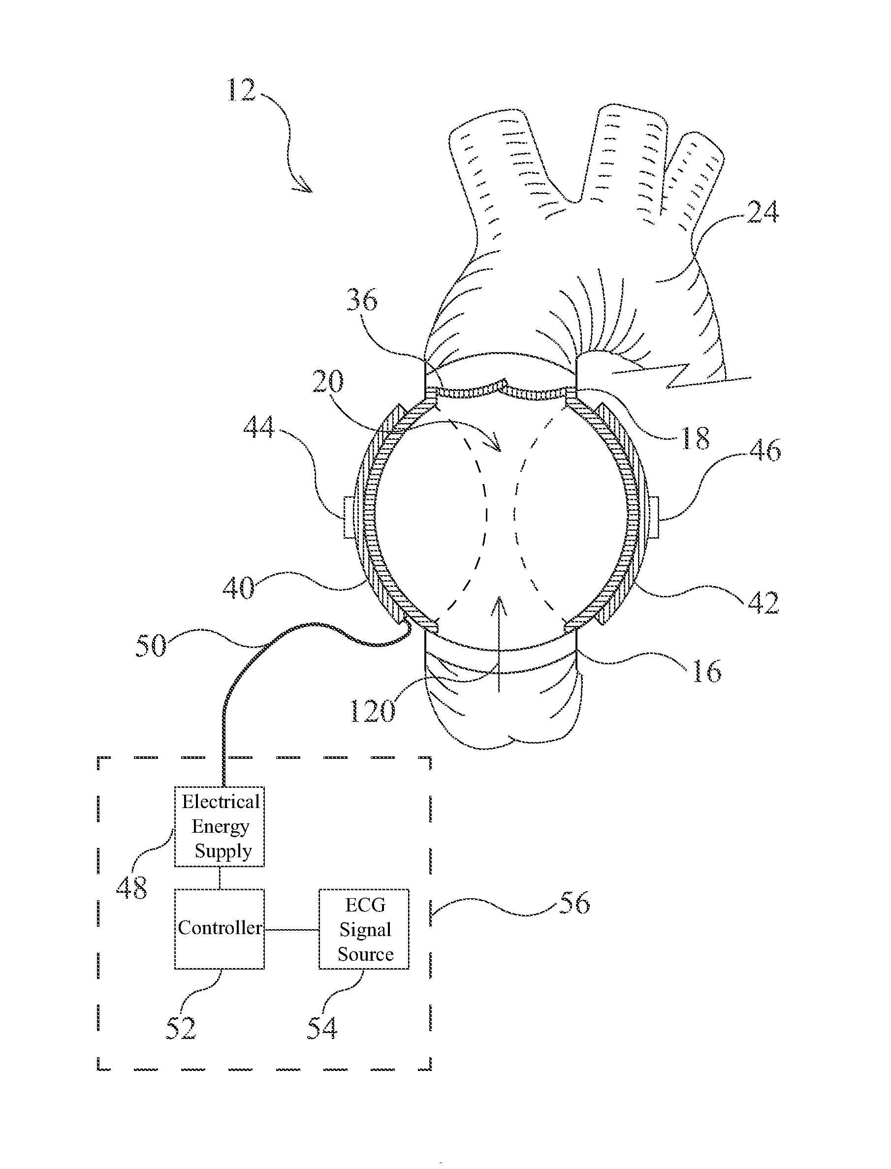 Artificial Ventricles