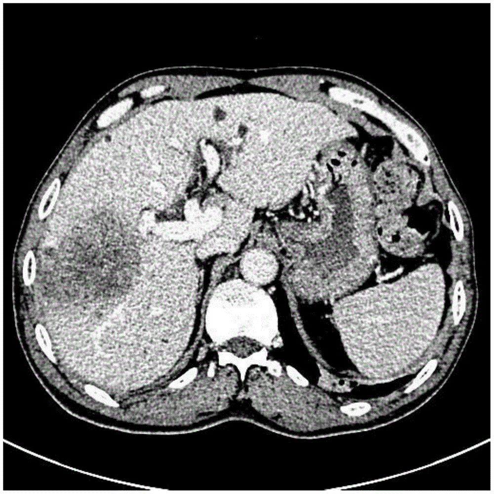 Tumor region image enhancement method and system based on enhanced composite image