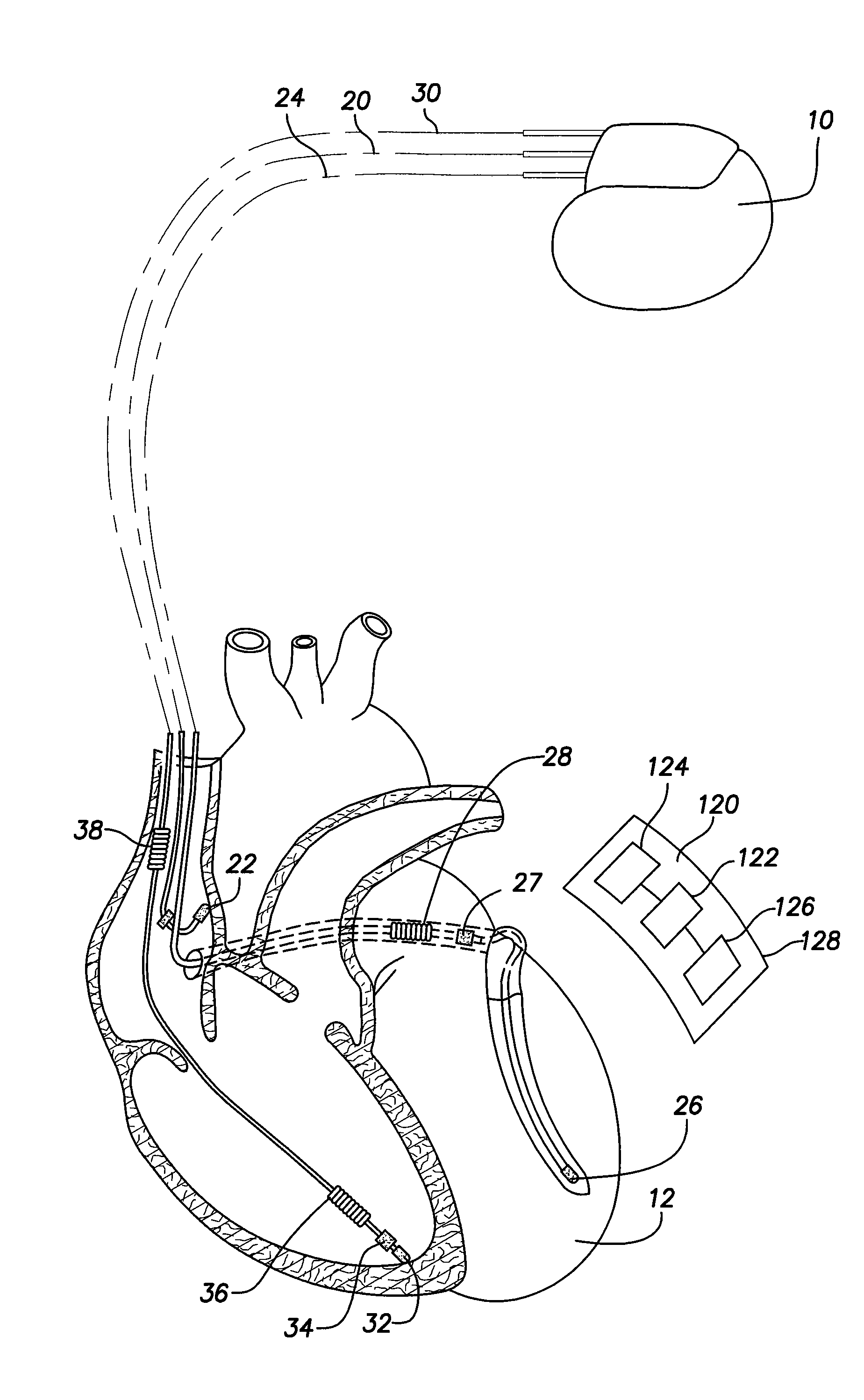 Subcutaneous cardiac stimulation device providing Anti-tachycardia pacing therapy and method