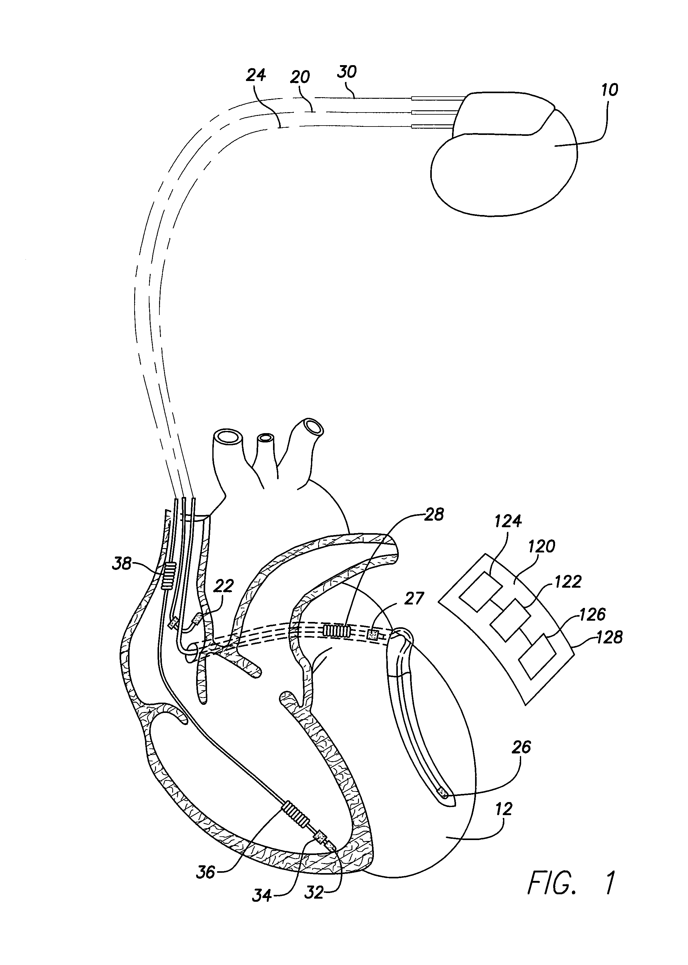 Subcutaneous cardiac stimulation device providing Anti-tachycardia pacing therapy and method