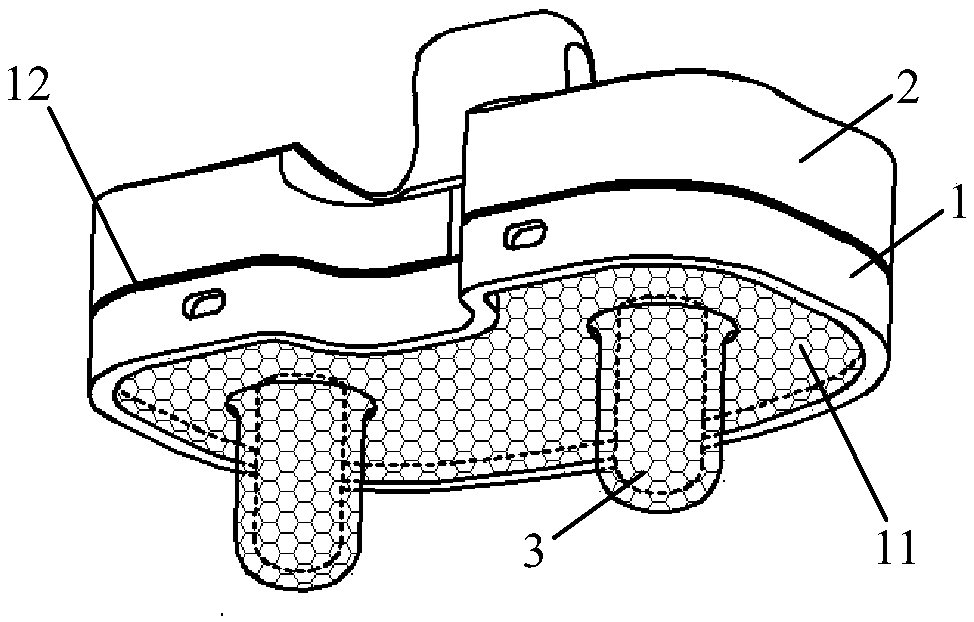 Uncemented tibial component of trabecular structure and making method of uncemented tibial component