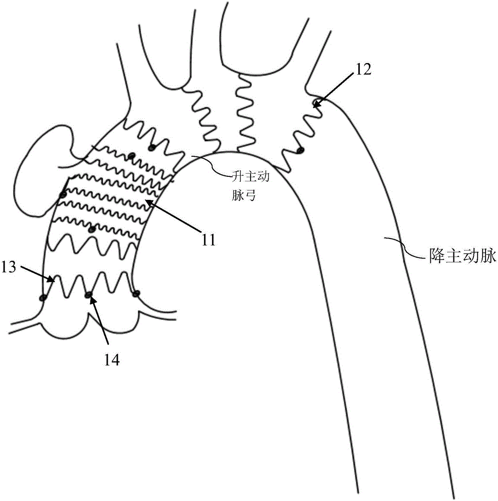 Isolating transplanting devicein aorta ascendens cavity