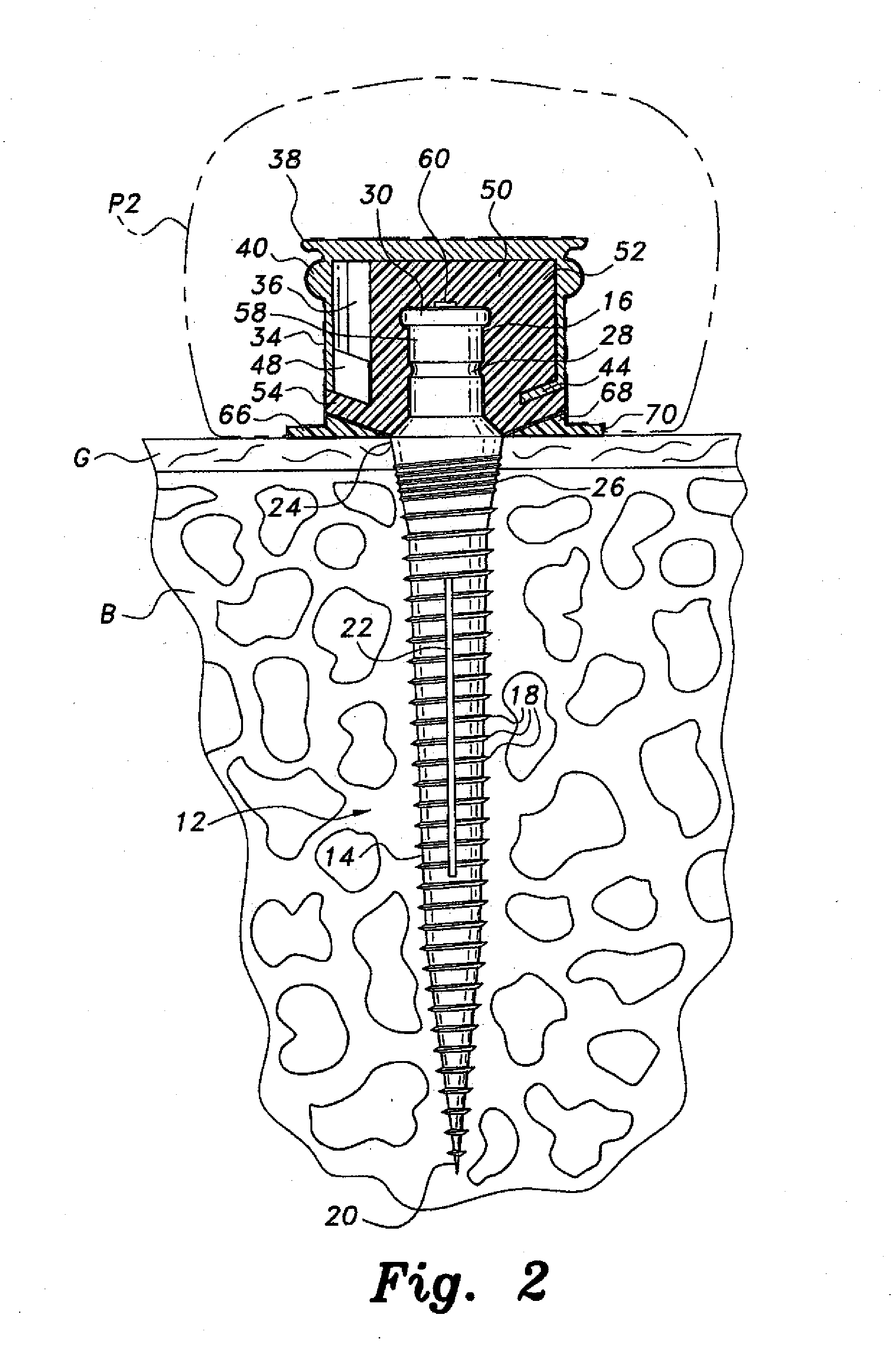 Dental implant system