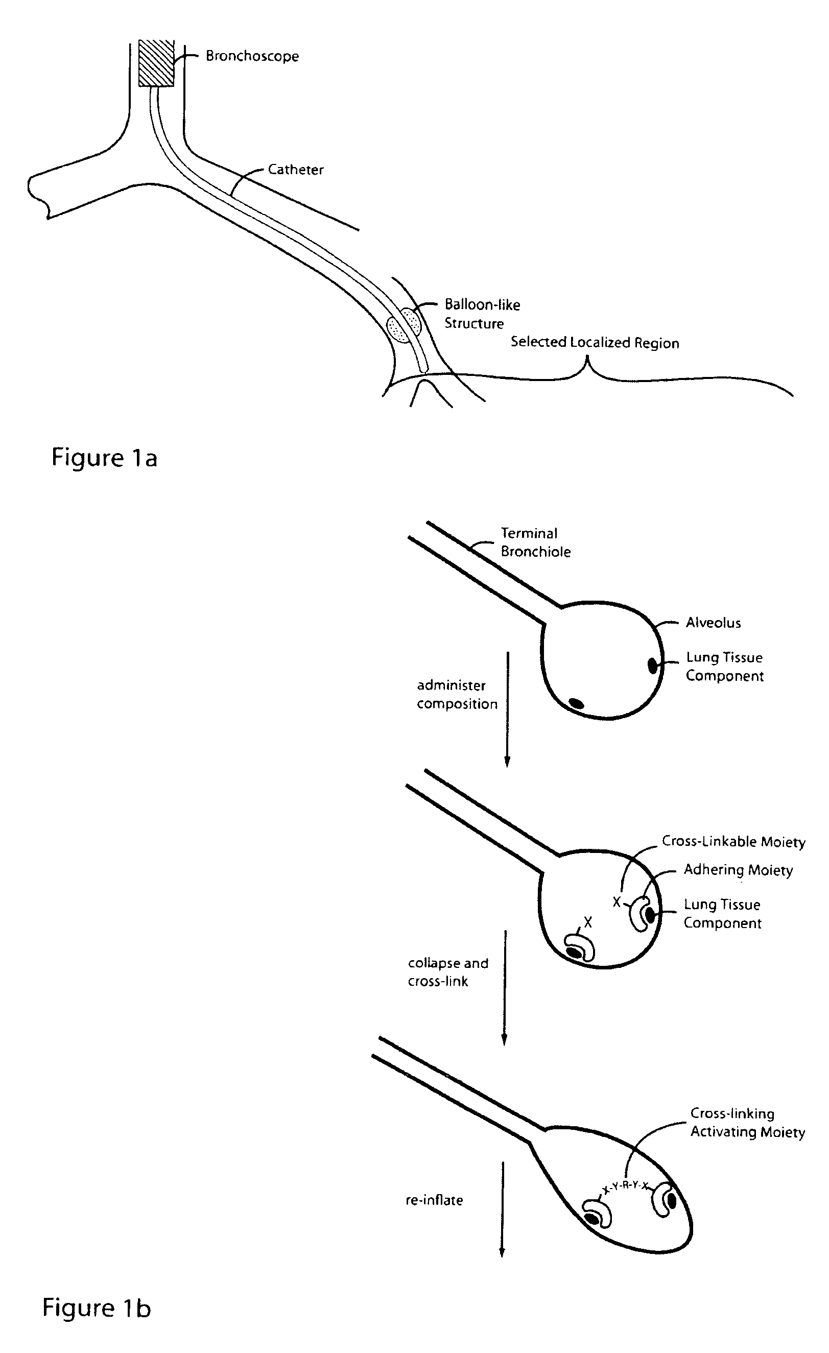 Lung volume reduction using glue compositions