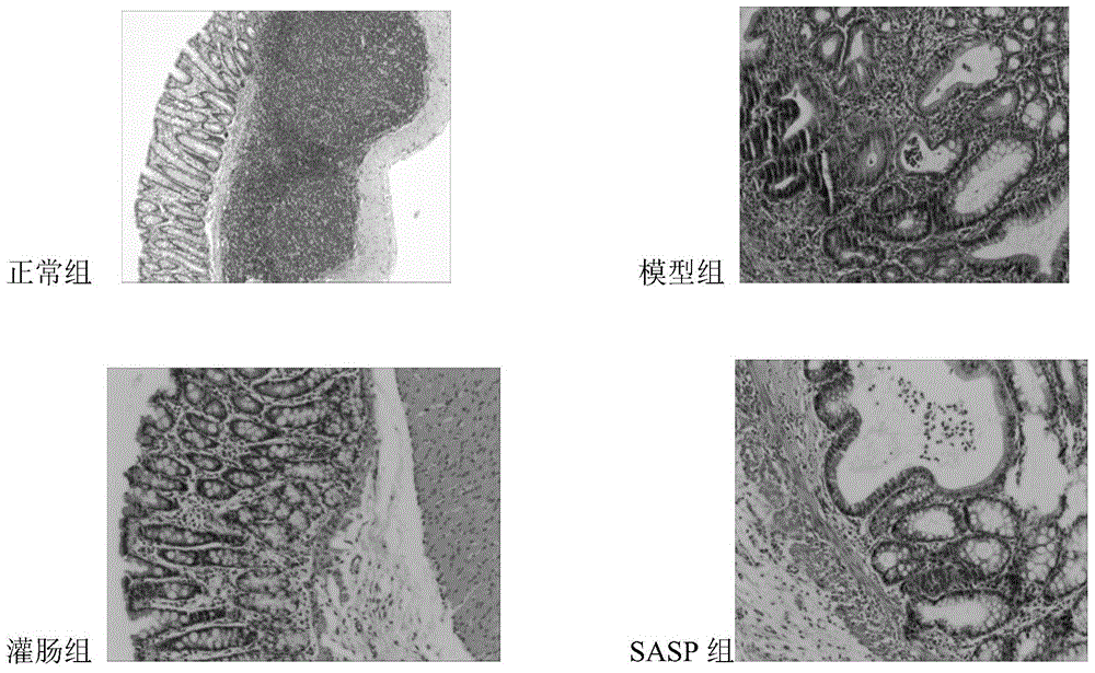 Compound medicine for ulcerative colitis enema treatment and preparation method and application thereof