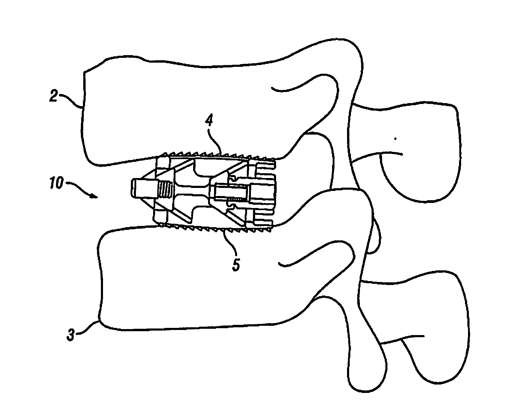 Expandable Fusion Device and Method of Installation Thereof