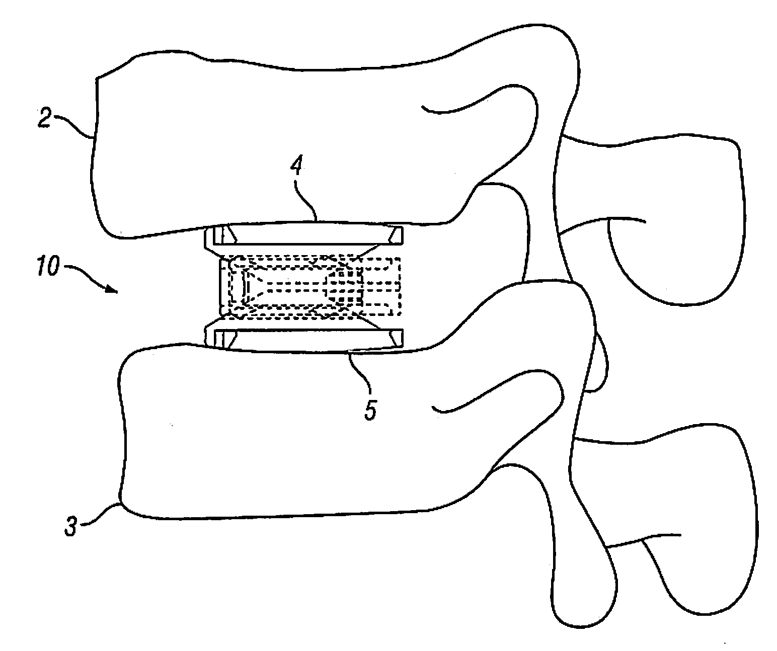 Expandable Fusion Device and Method of Installation Thereof