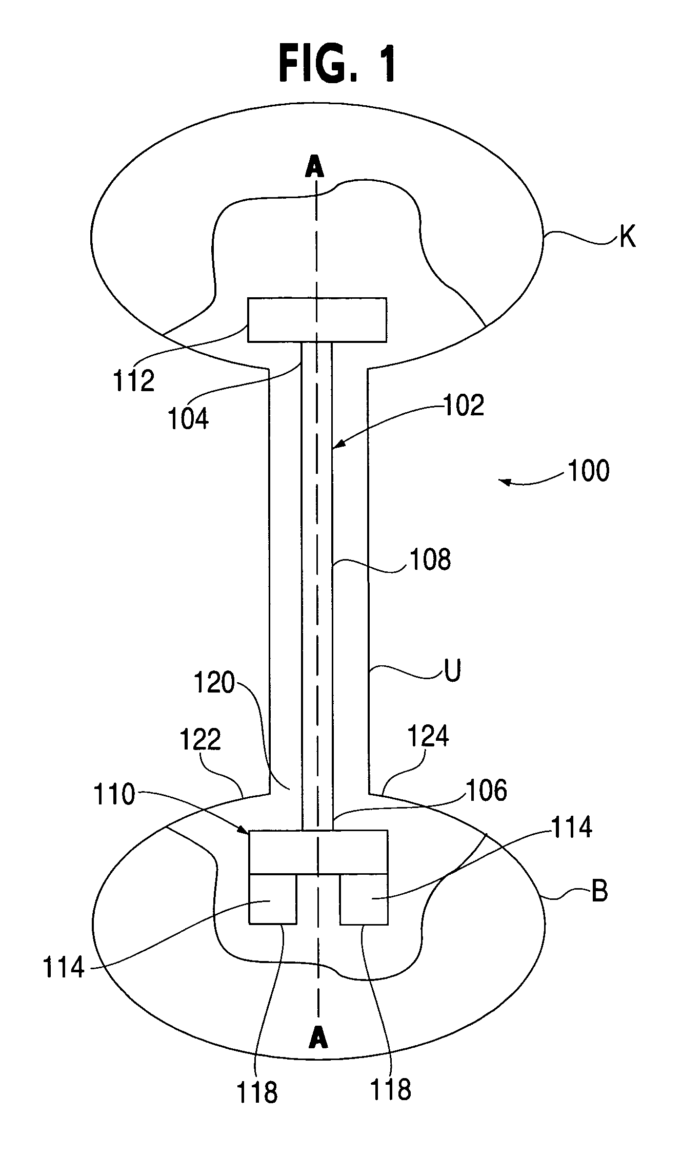 Ureteral stent with conforming retention structure