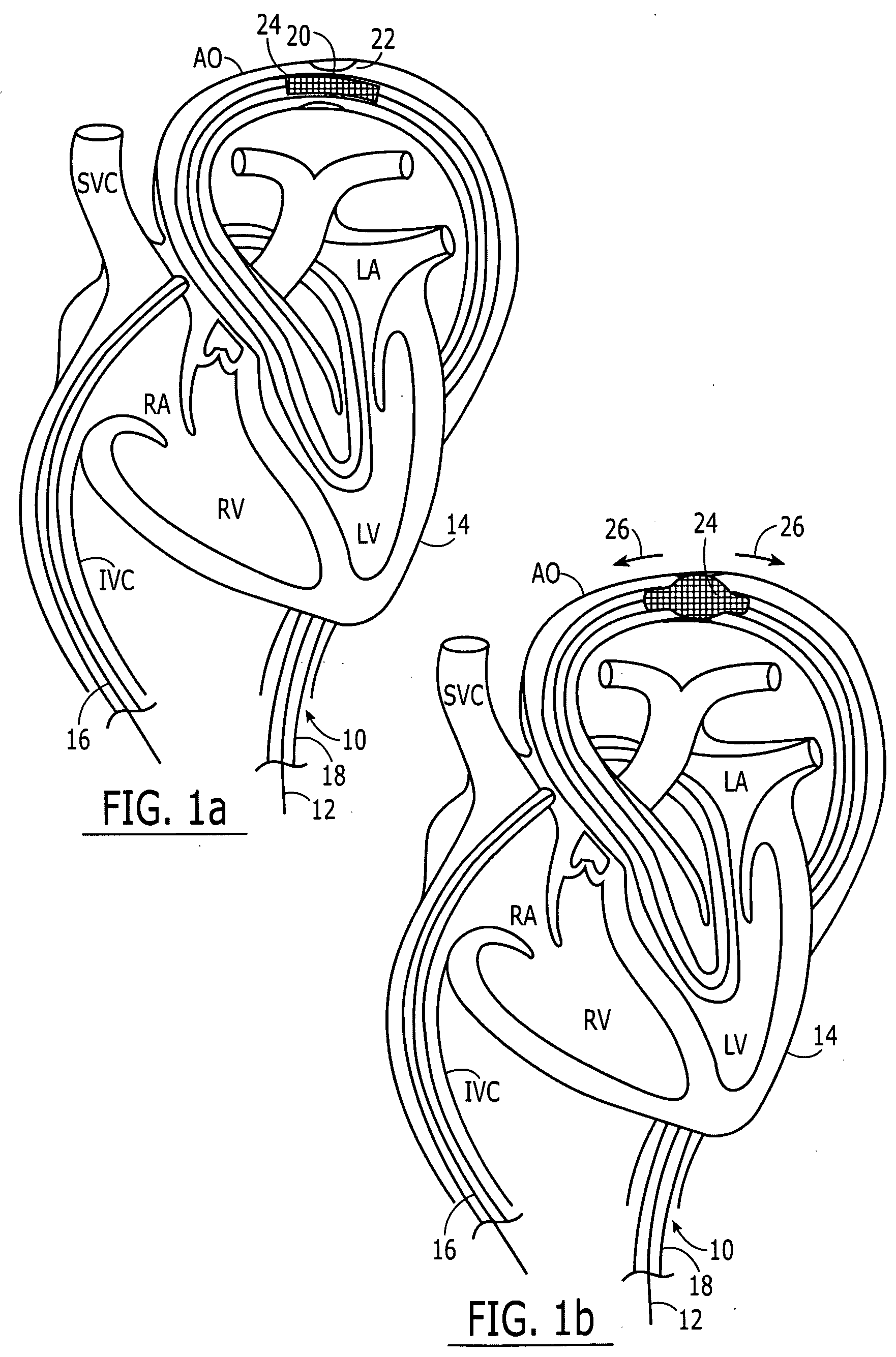 Separable sheath and method for insertion of a medical device into a bodily vessel using a separable sheath