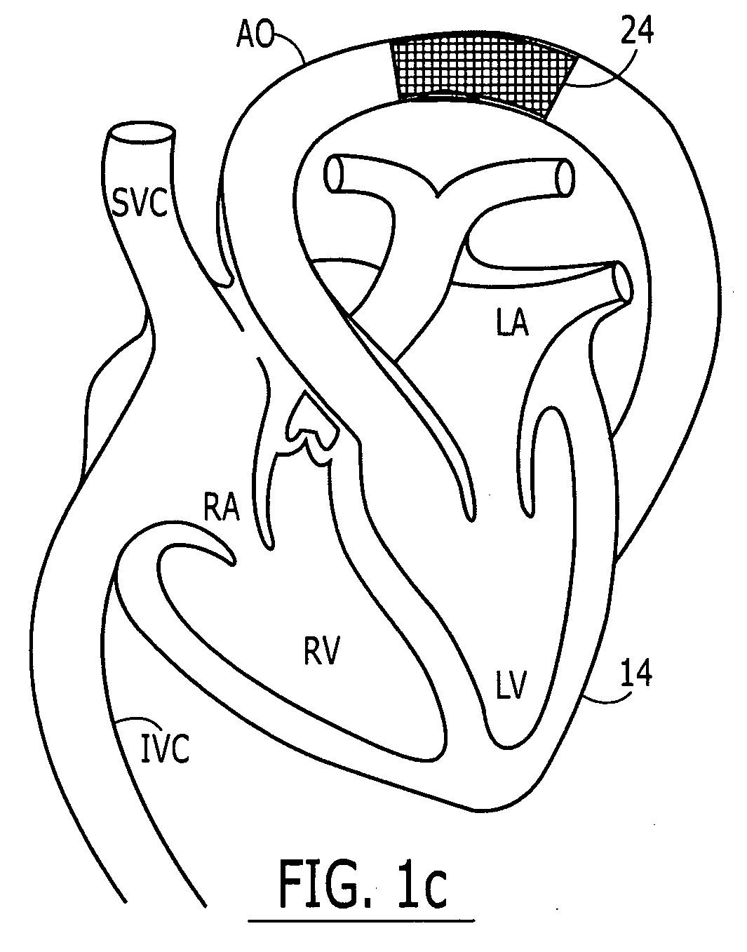 Separable sheath and method for insertion of a medical device into a bodily vessel using a separable sheath