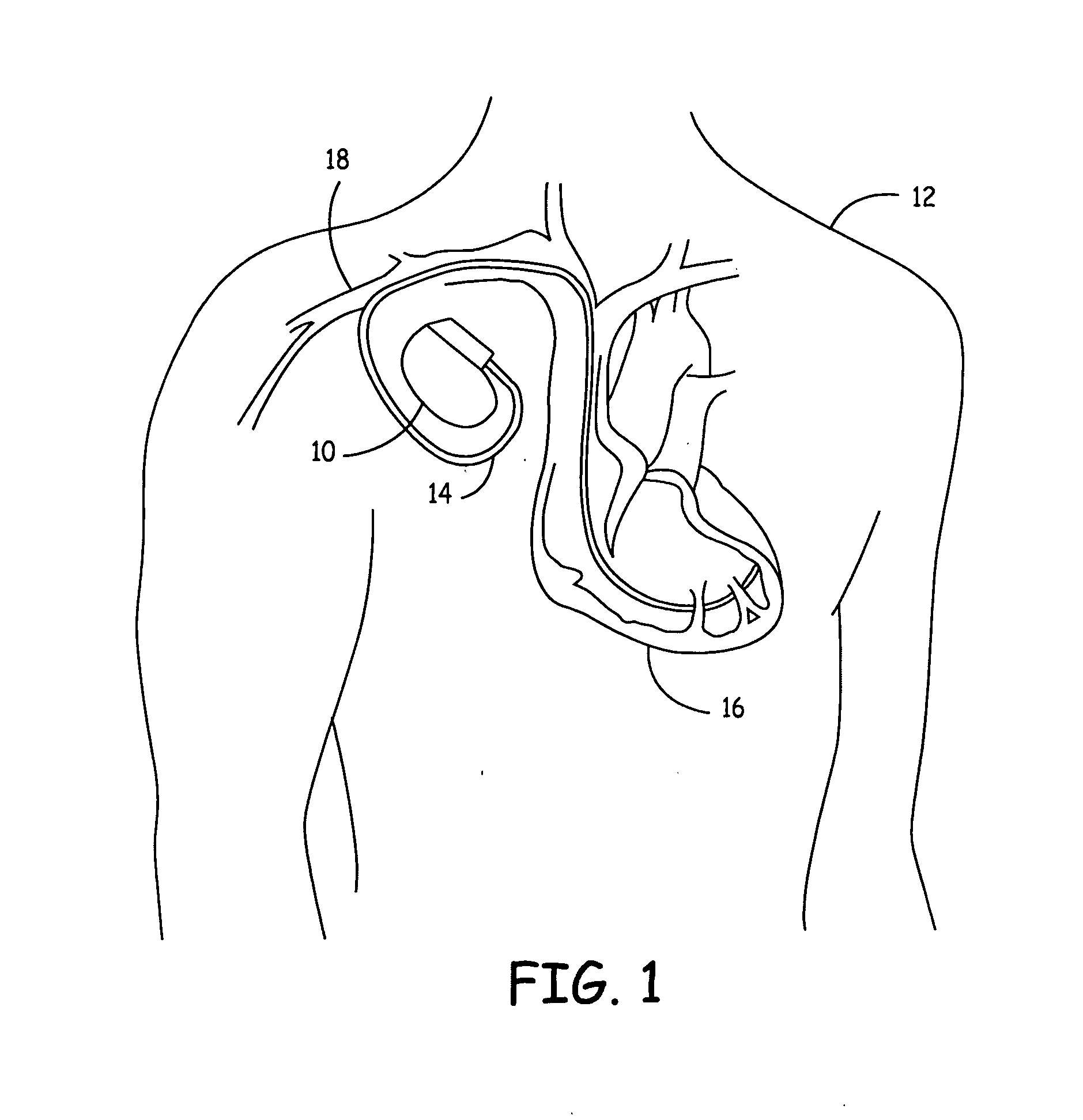 Method for reducing implantable defibrillator volume