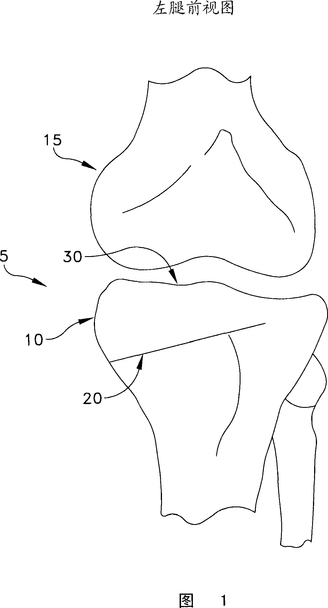 Method and apparatus for performing an open wedge, high tibial osteotomy