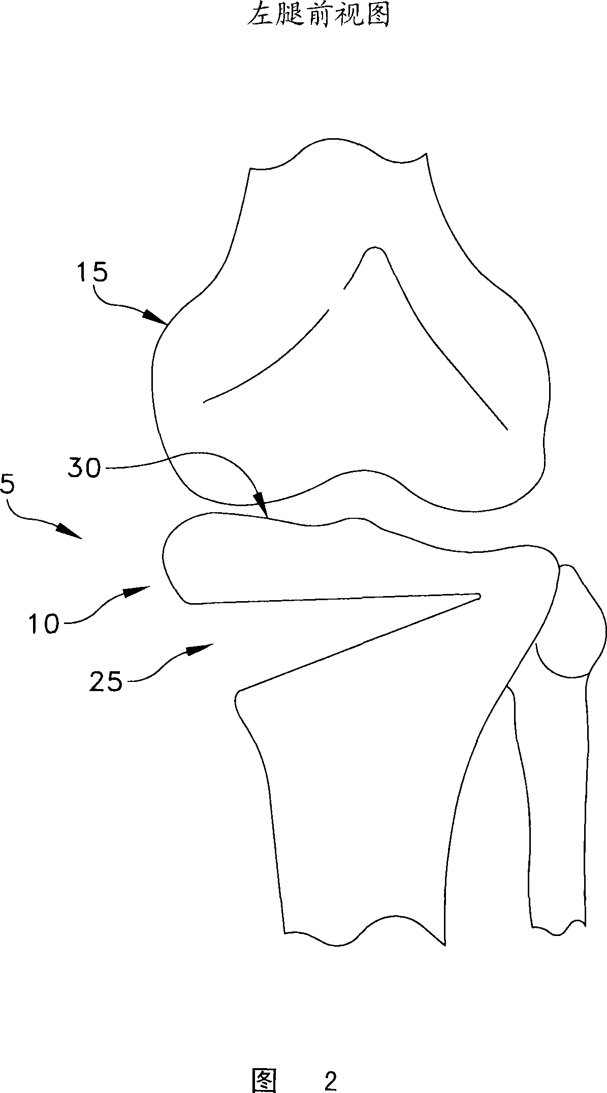 Method and apparatus for performing an open wedge, high tibial osteotomy