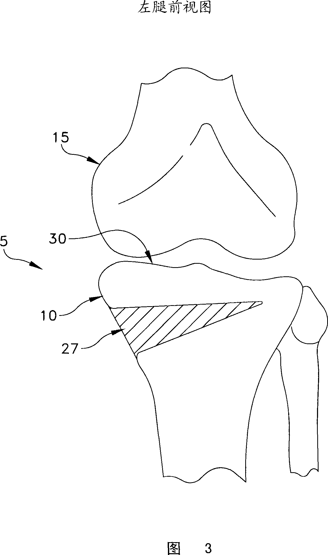 Method and apparatus for performing an open wedge, high tibial osteotomy