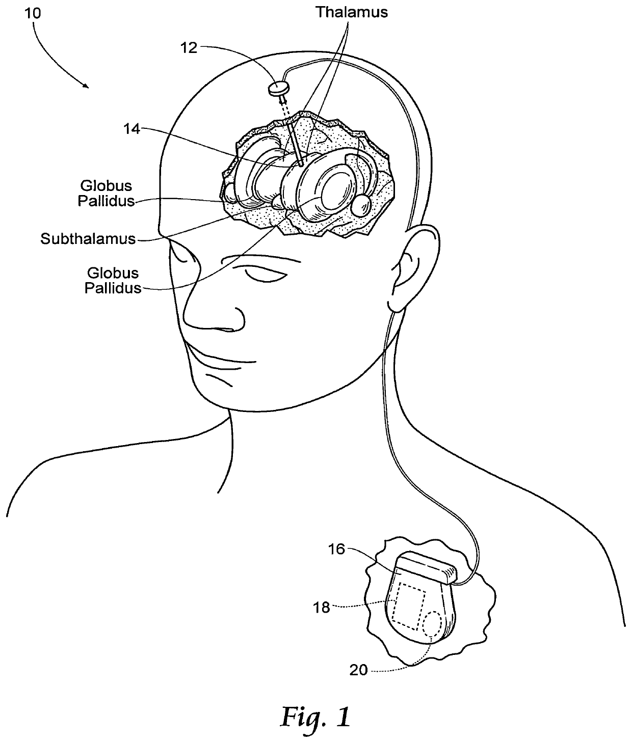 Non-regular electrical stimulation patterns for treating neurological disorders