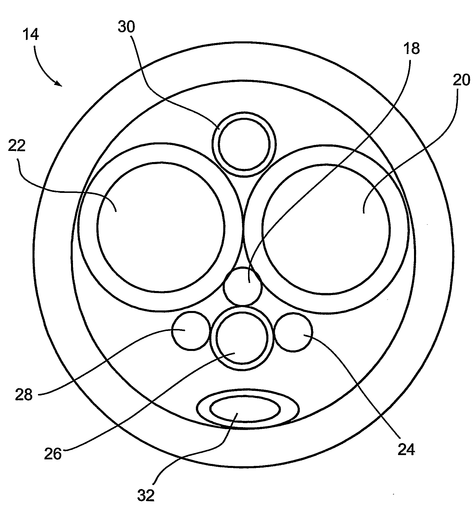 Shock-Wave Generating Device, Such as for the Treatment of Calcific Aortic Stenosis