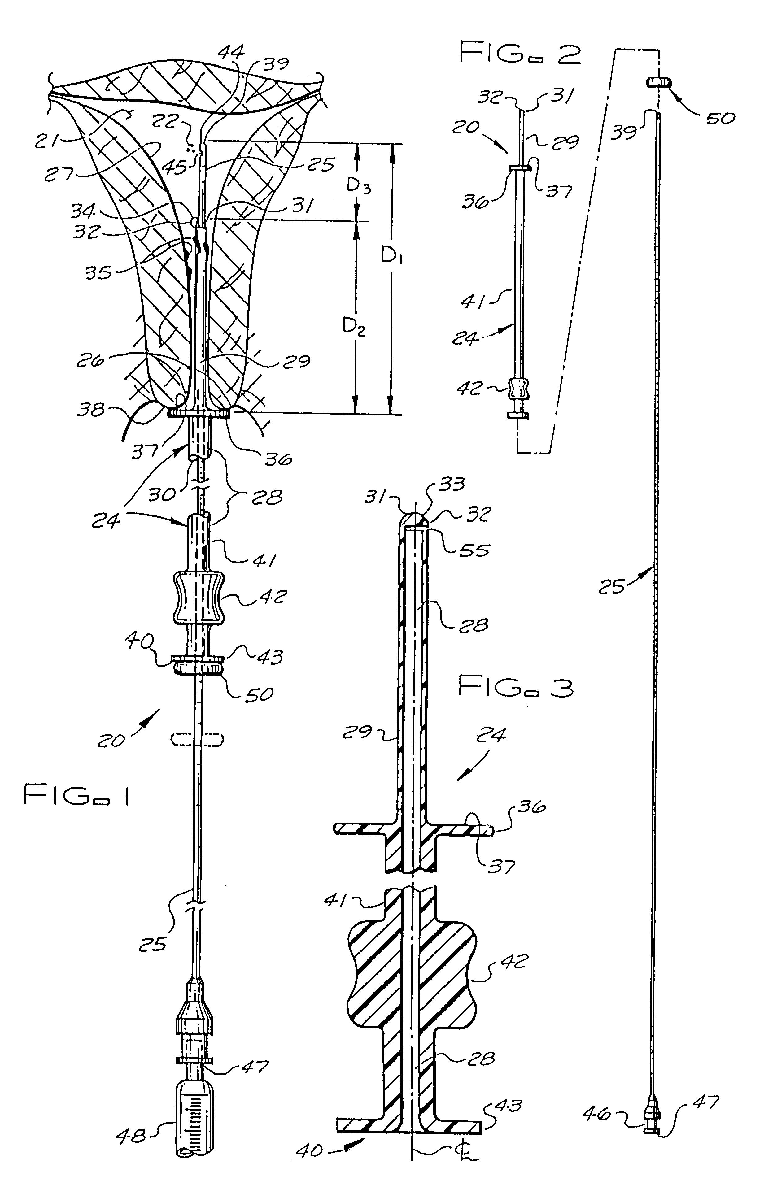 Catheter system for implanting embryos