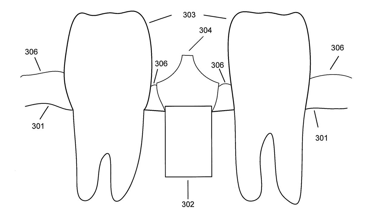 Using a cbct bone scan to design a dental abutment