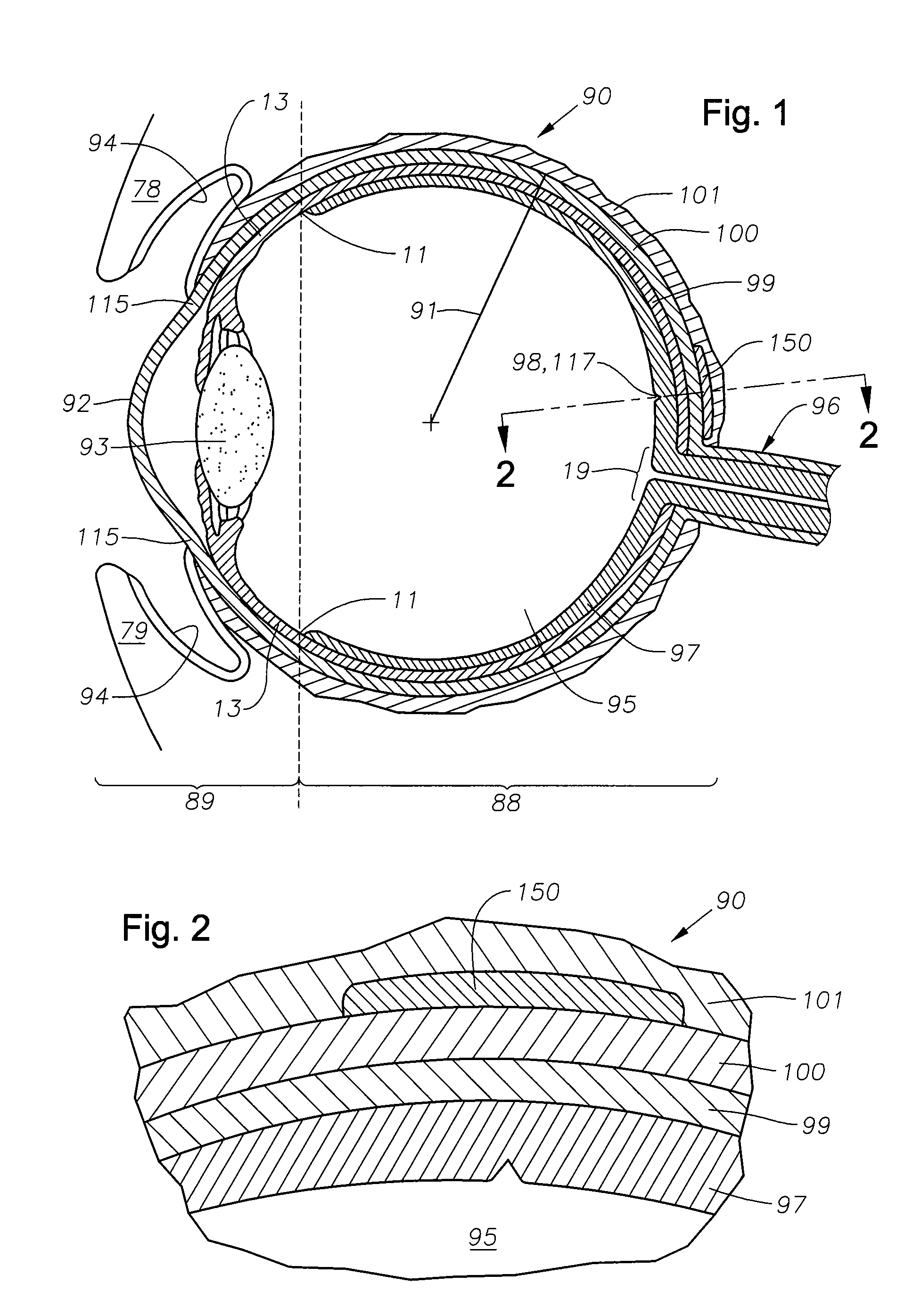 Juxtascleral drug delivery and ocular implant system