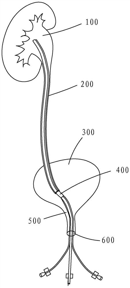 Renal pelvis pressure monitoring balloon perfusion catheter