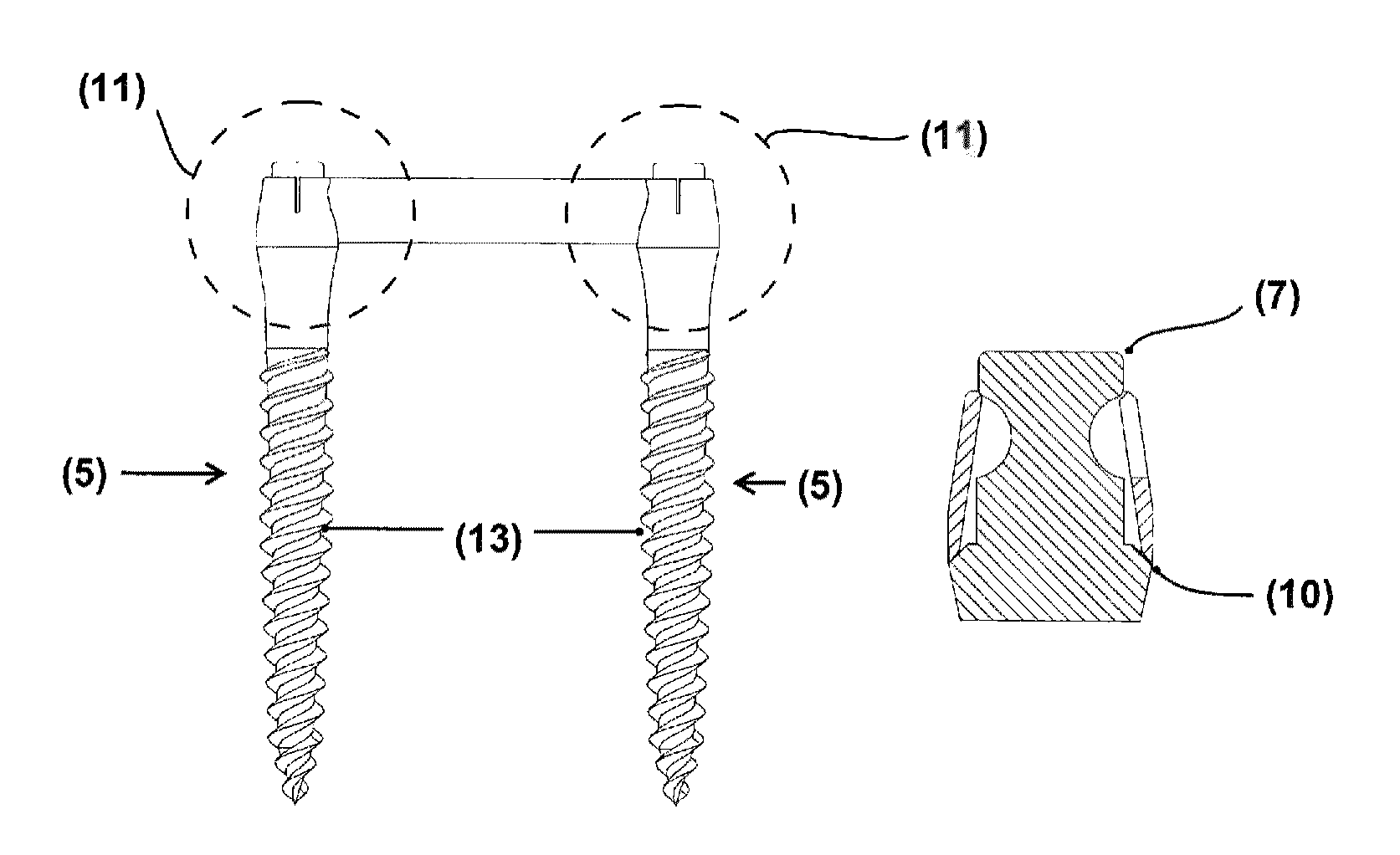 Prosthetic retention system for edentulous patients consisting of a prefabricated bar and two implants