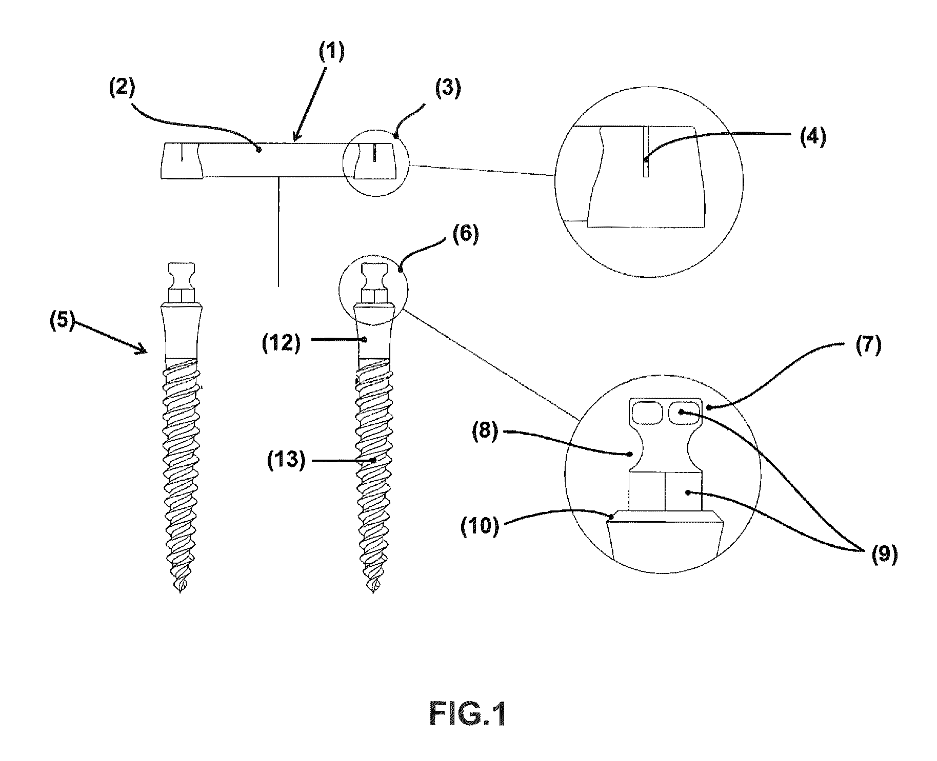 Prosthetic retention system for edentulous patients consisting of a prefabricated bar and two implants