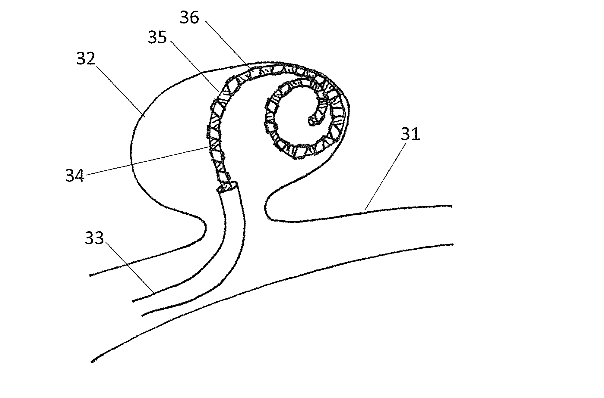 DEVICE AND METHOD FOR ENDOVASCULAR TREATMENT OF ANEURYSMS USING EMBOLIC ePTFE