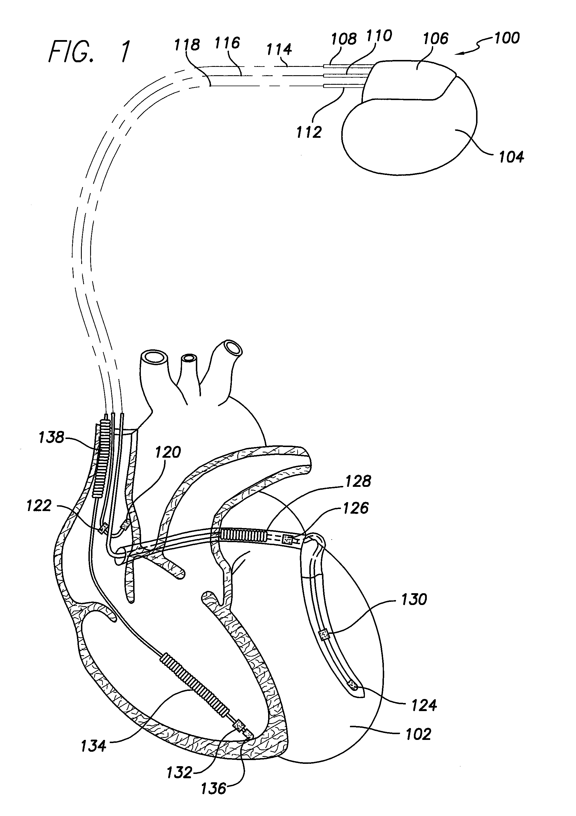 Methods and systems for discriminating between ventricular waveforms when ventricular rate exceeds atrial rate