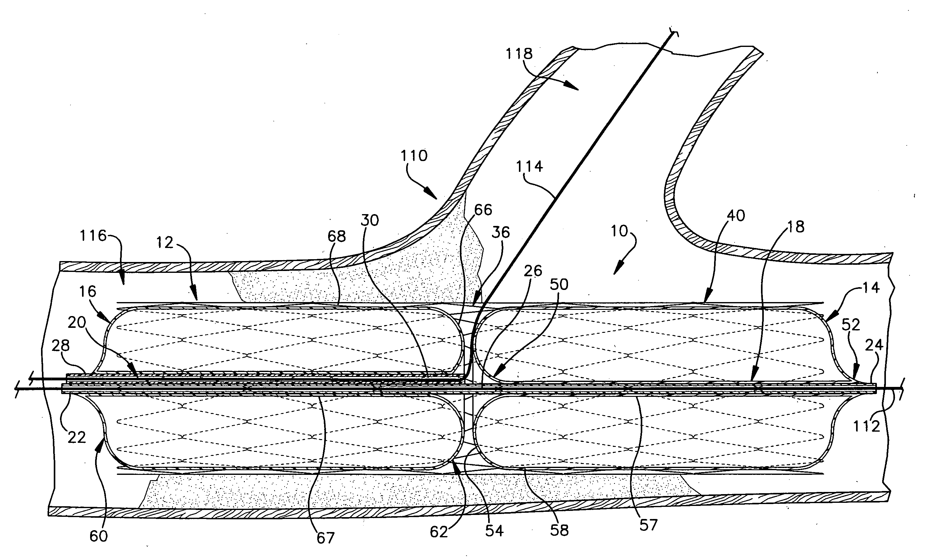 Apparatus for treating atherosclerosis