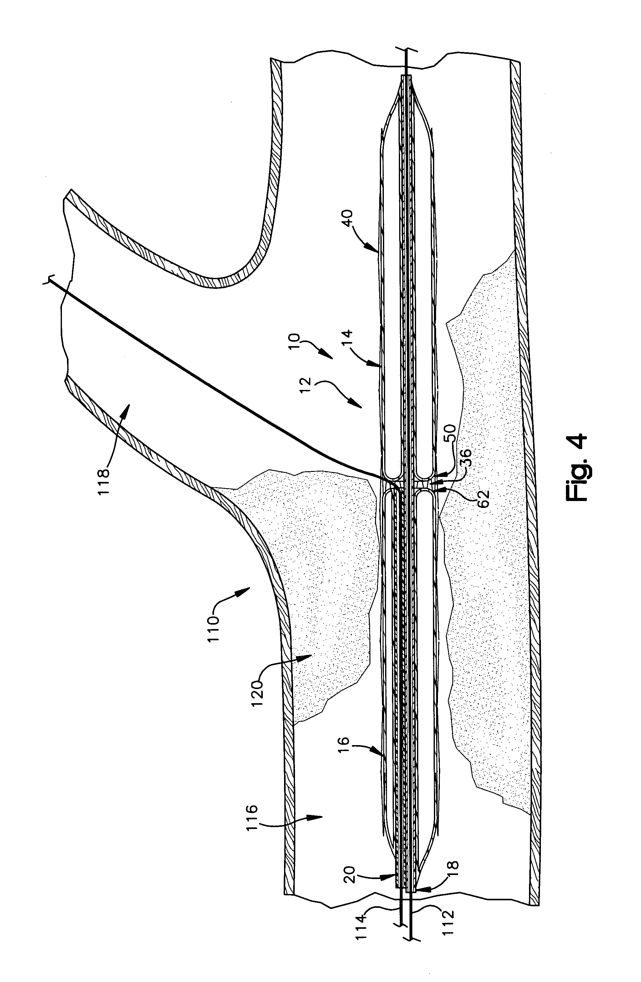 Apparatus for treating atherosclerosis