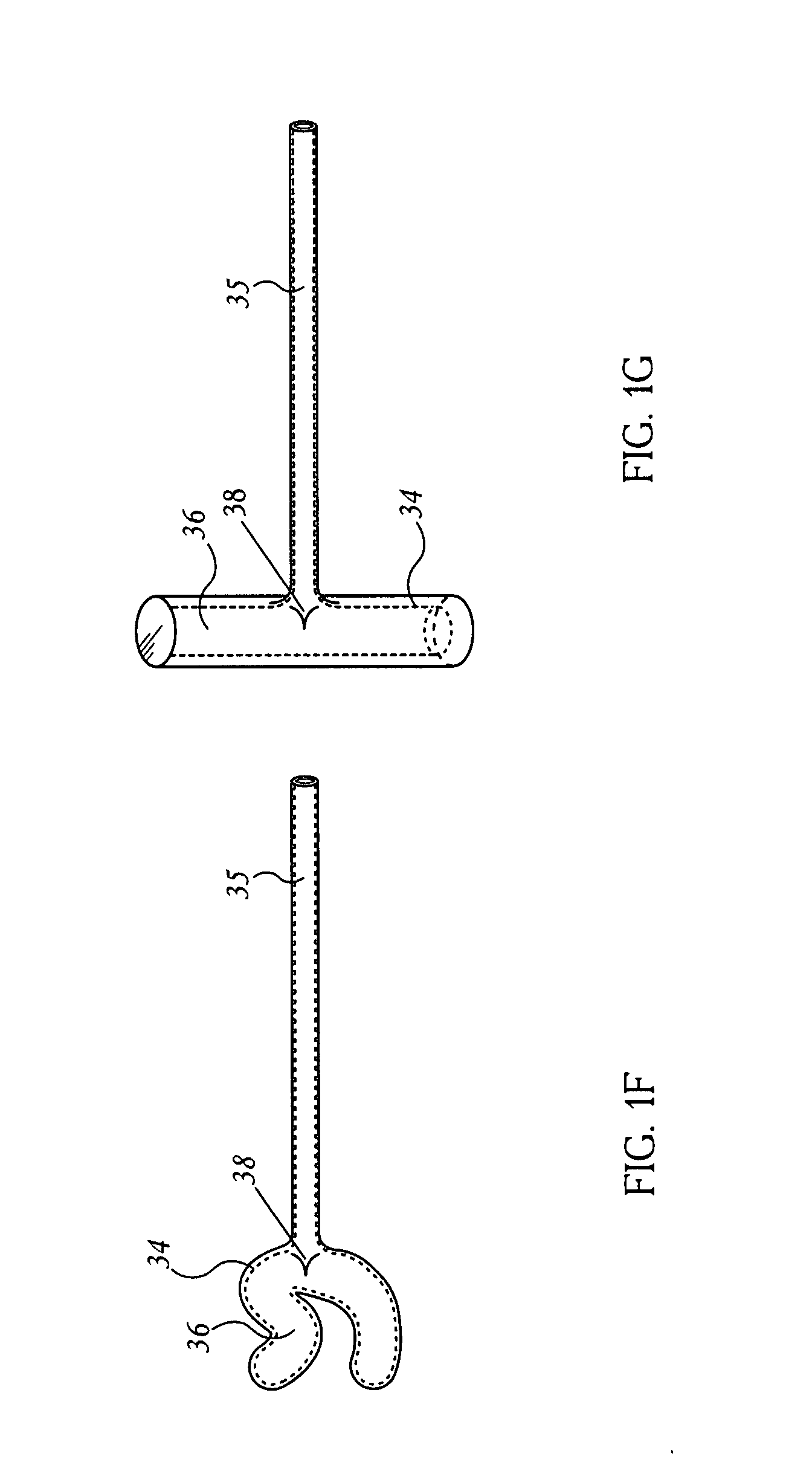 Extragastric Balloon With Attachment Tabs