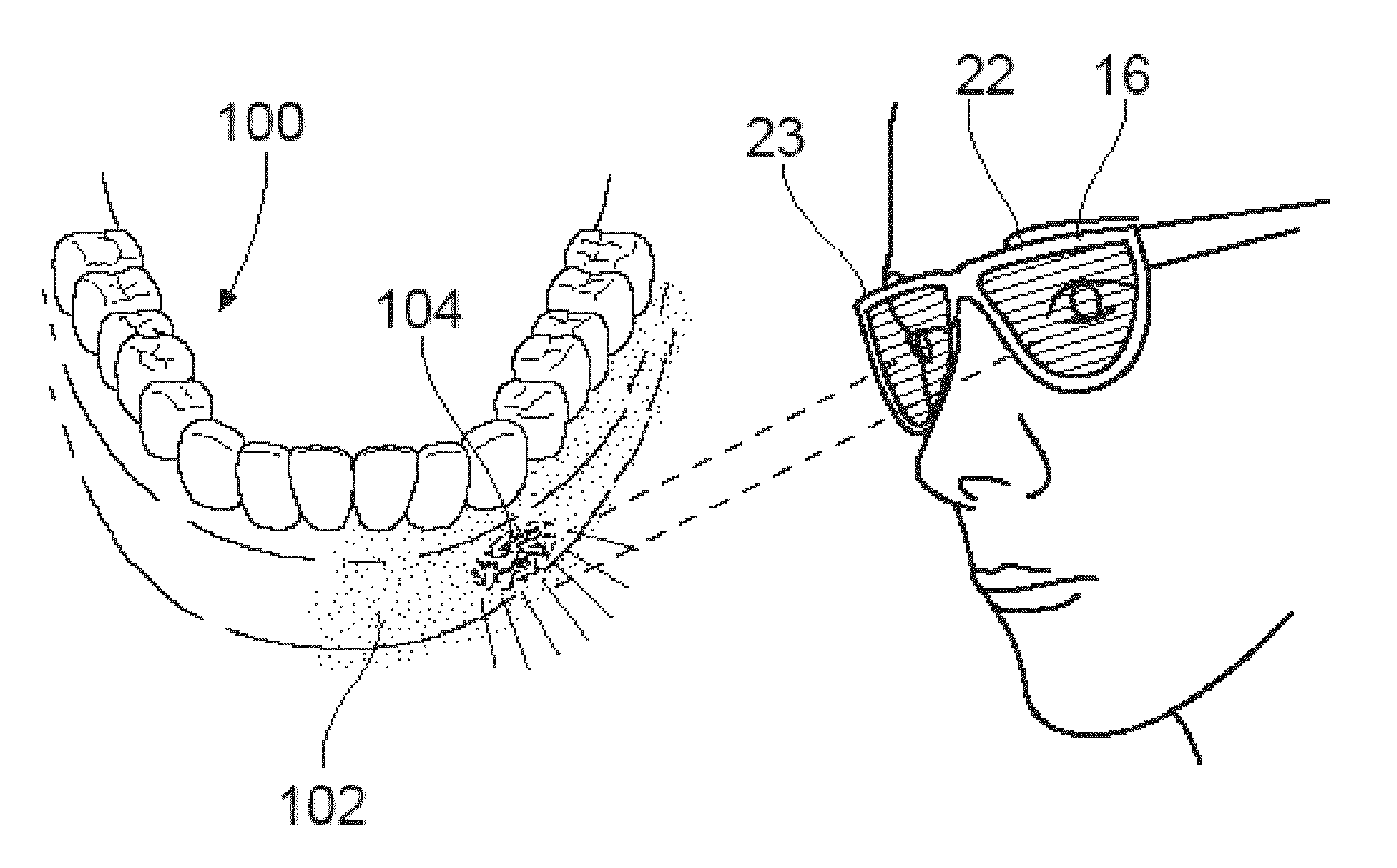 Compositions and methods for detecting oral neoplasm