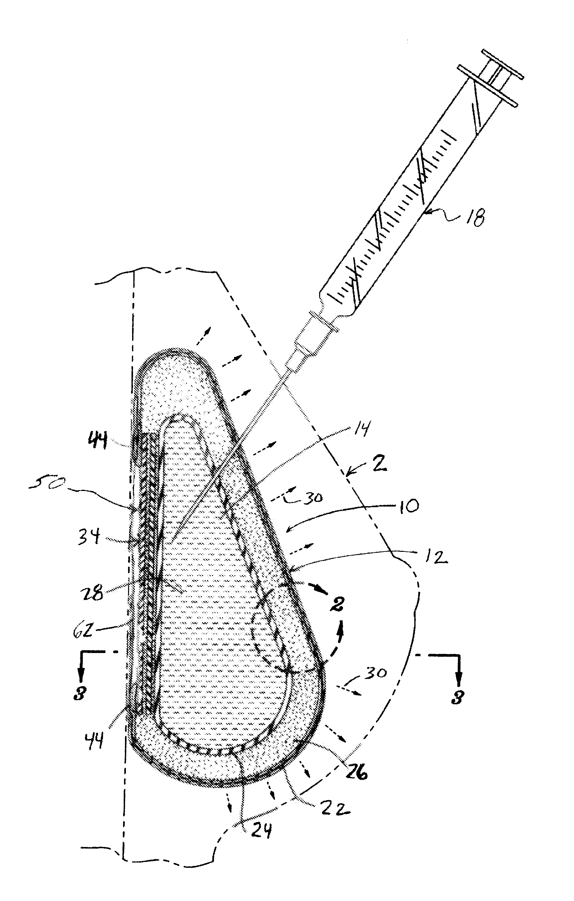 Inflatable prostheses and methods of making same