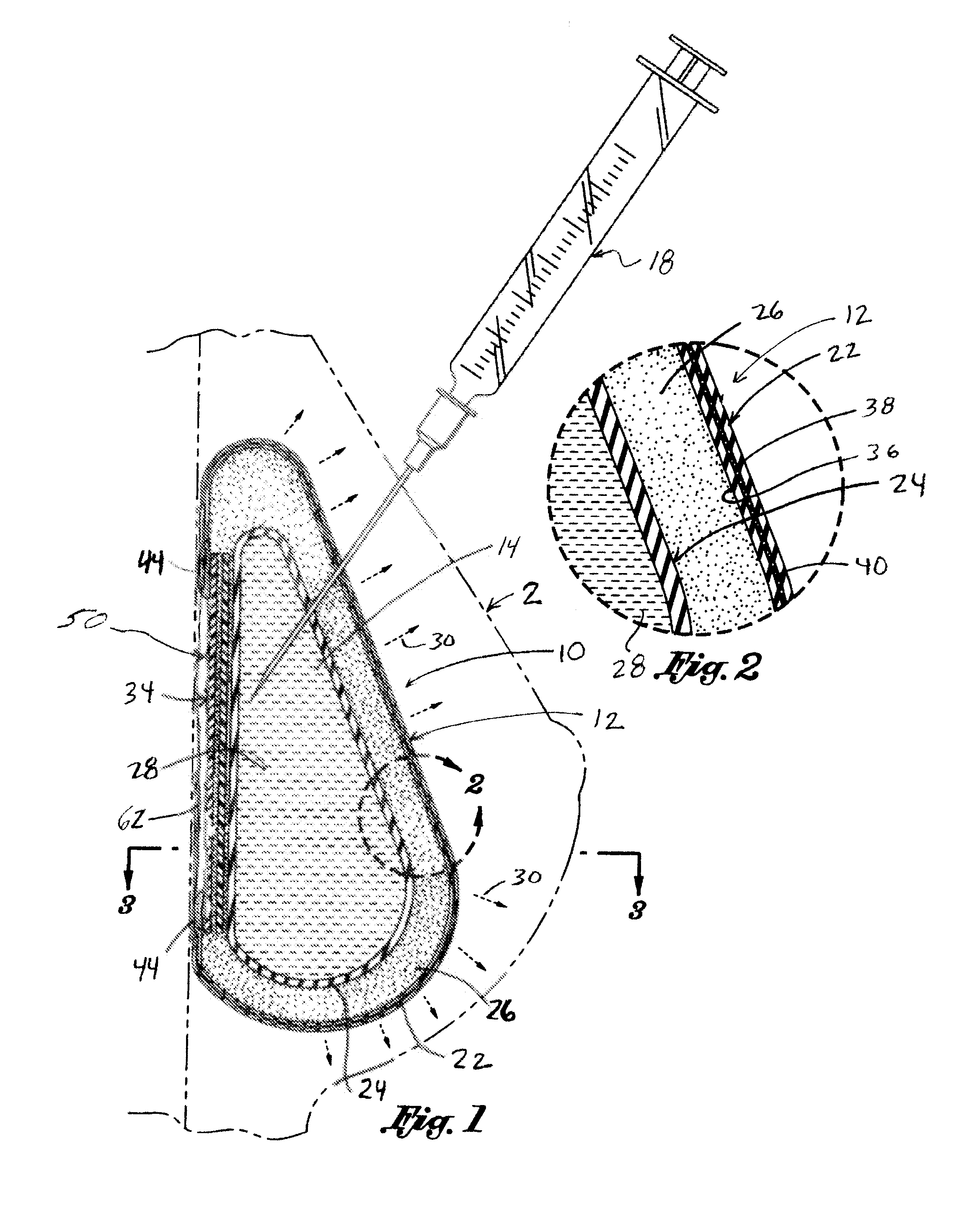 Inflatable prostheses and methods of making same