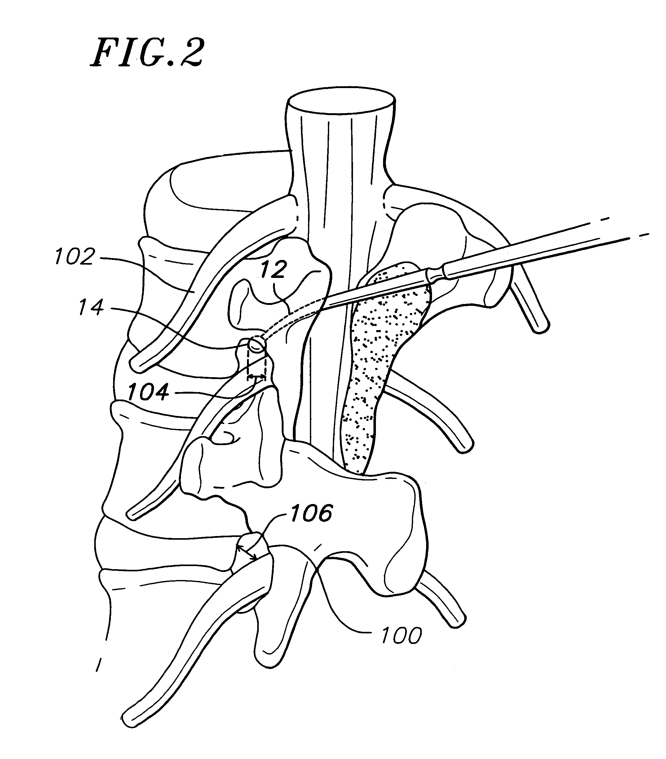 Method for locating, measuring, and evaluating the enlargement of a foramen