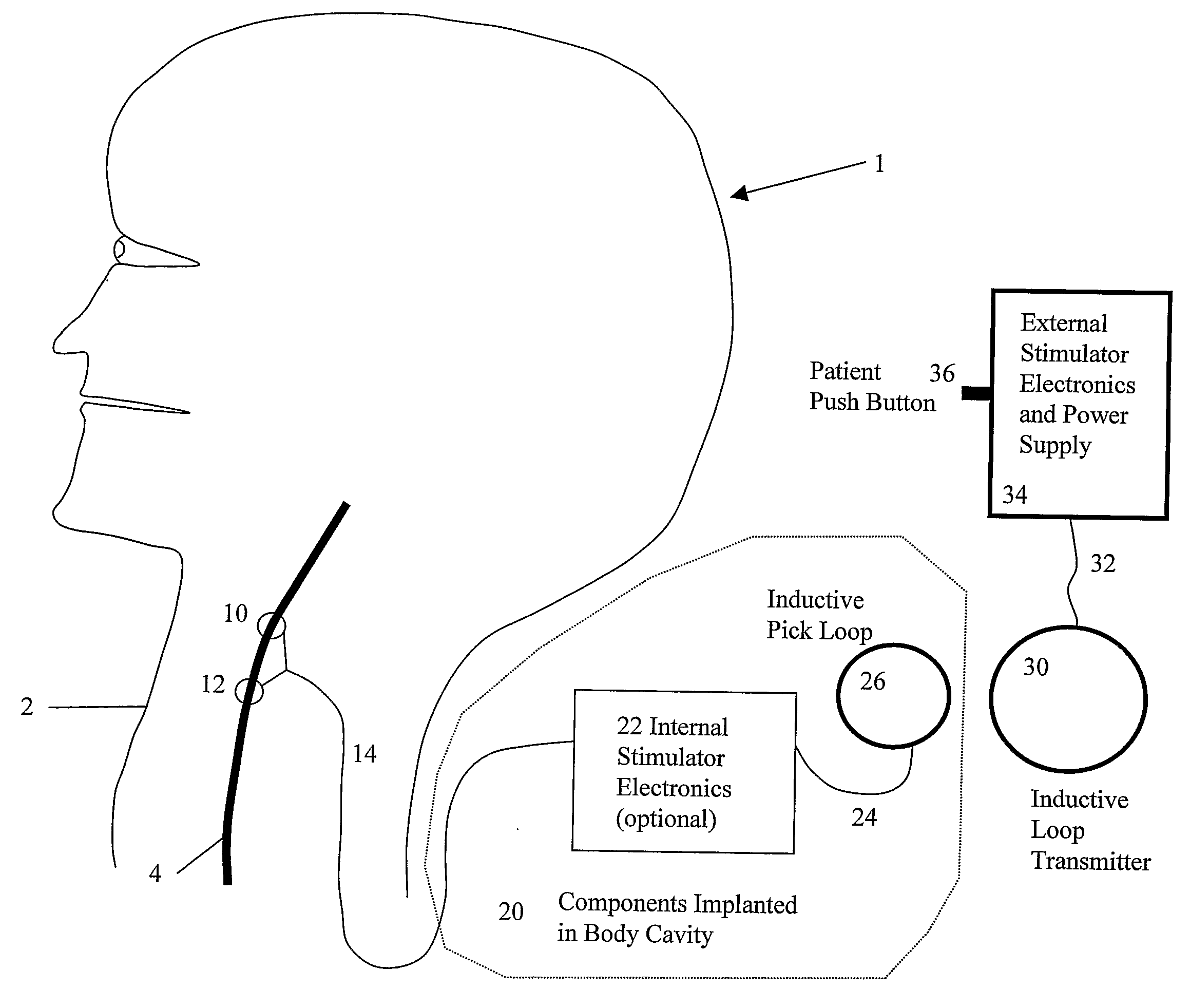 System and Method for Treating Nausea and Vomiting by Vagus Nerve Stimulation