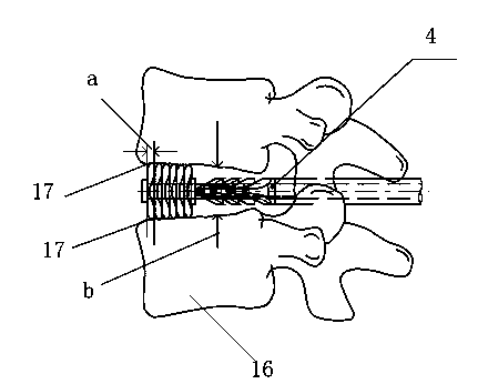 Formatted contact-surface adaptation type full support interbody fusion cage