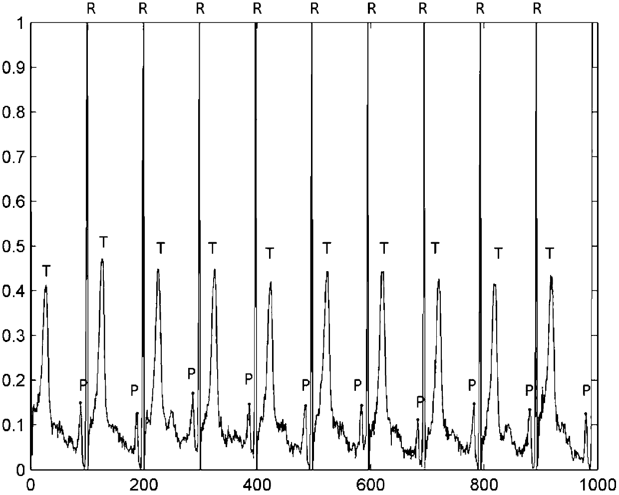 Electrocardiosignal data processing method