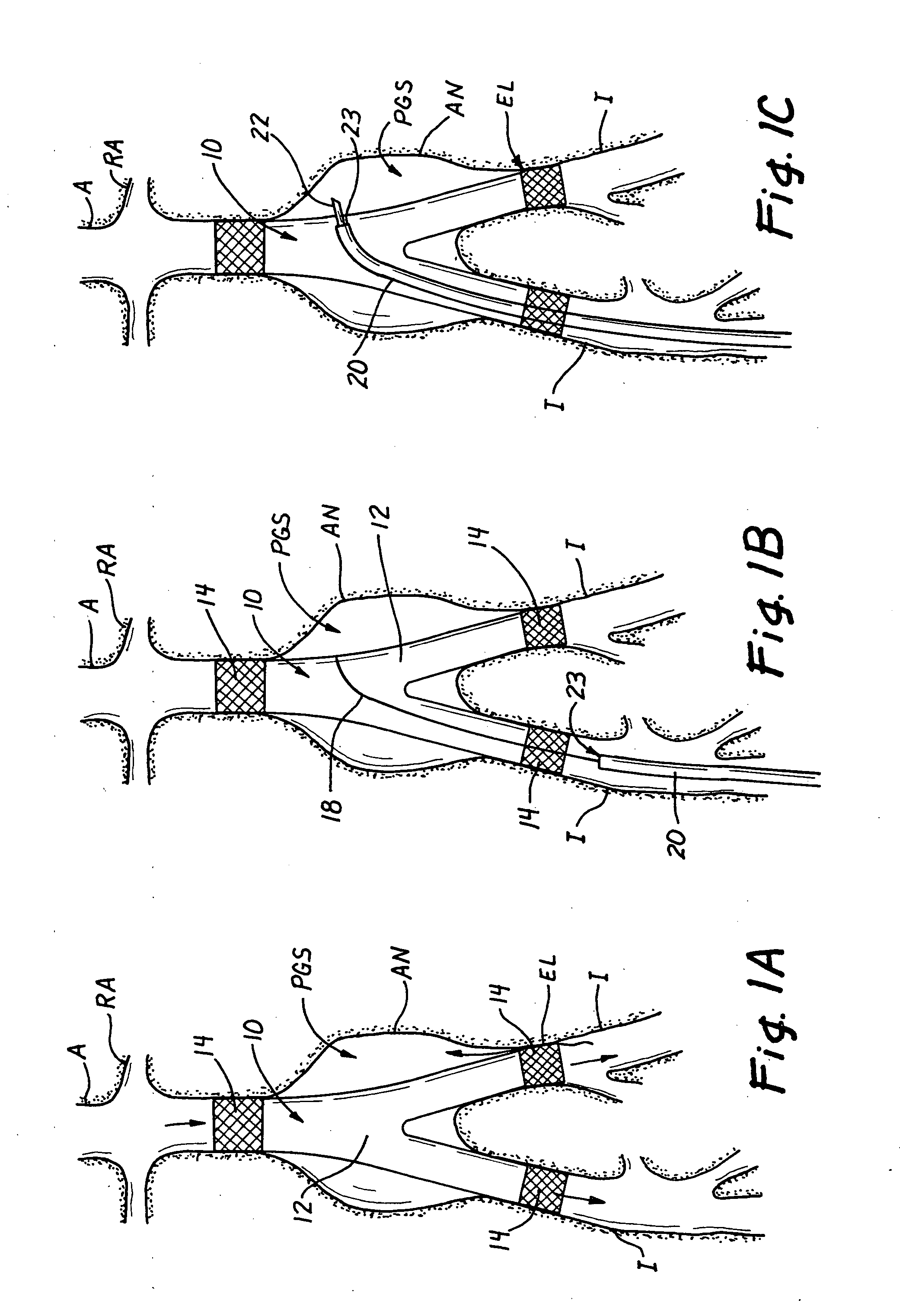 Methods, materials and apparatus for deterring or preventing endoleaks following endovascular graft implantation