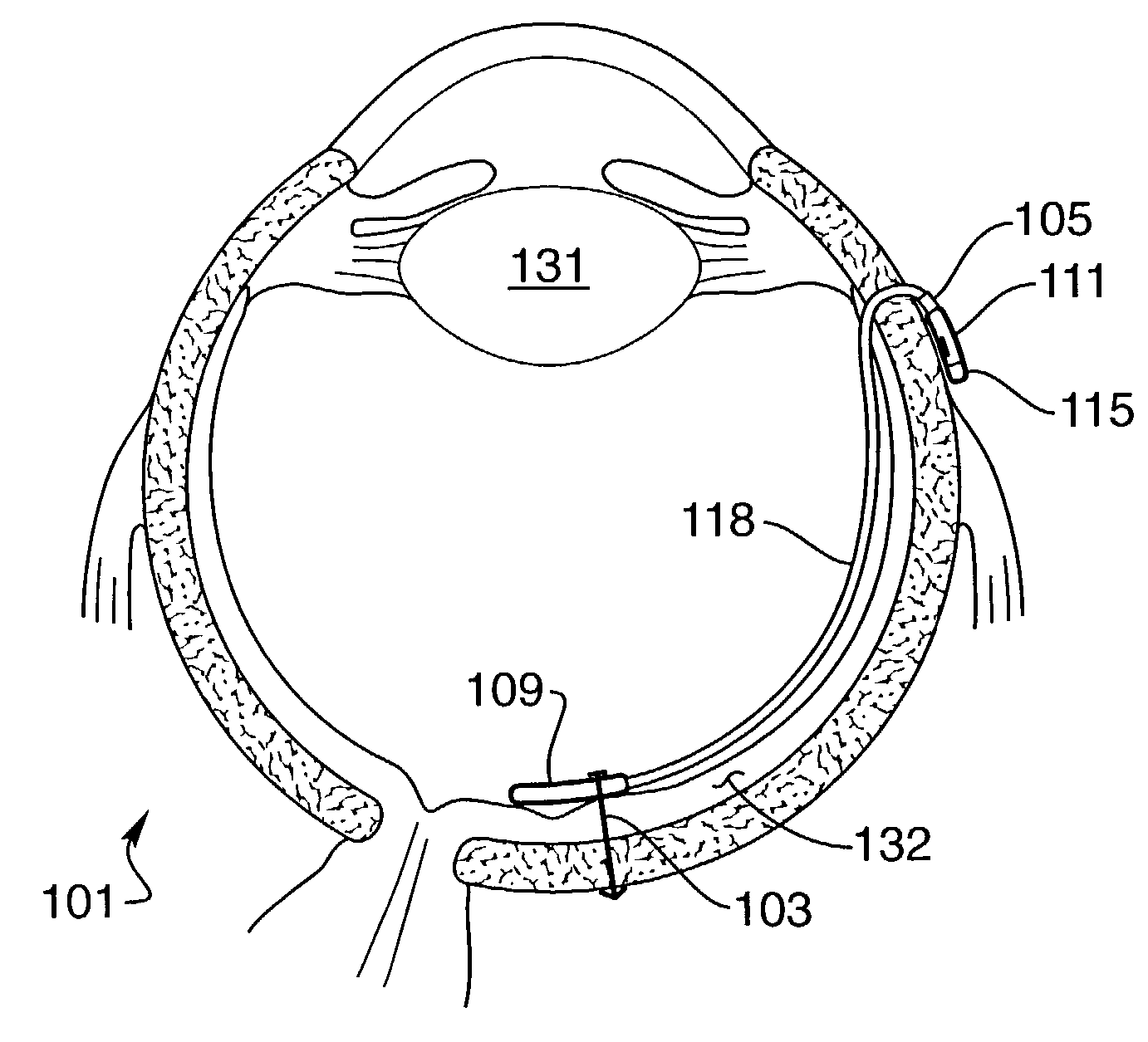 Implantable drug delivery device