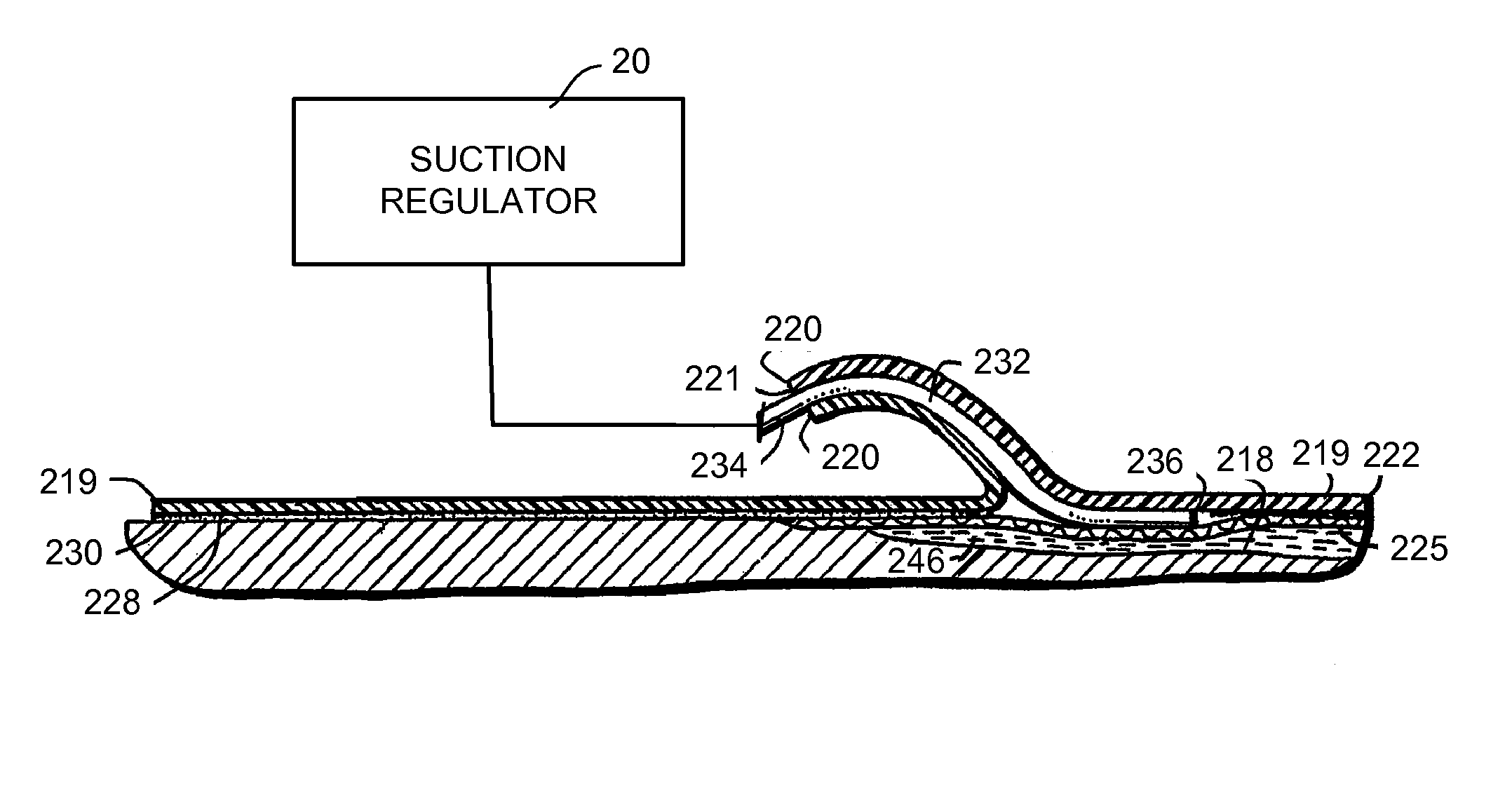 Wound treatment system and suction regulator for use therewith