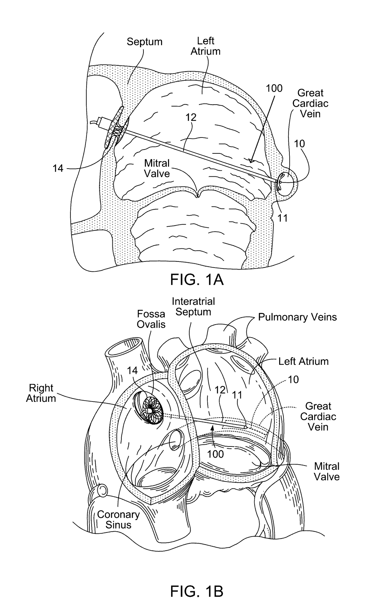 Devices, systems, and methods for reshaping a heart valve annulus